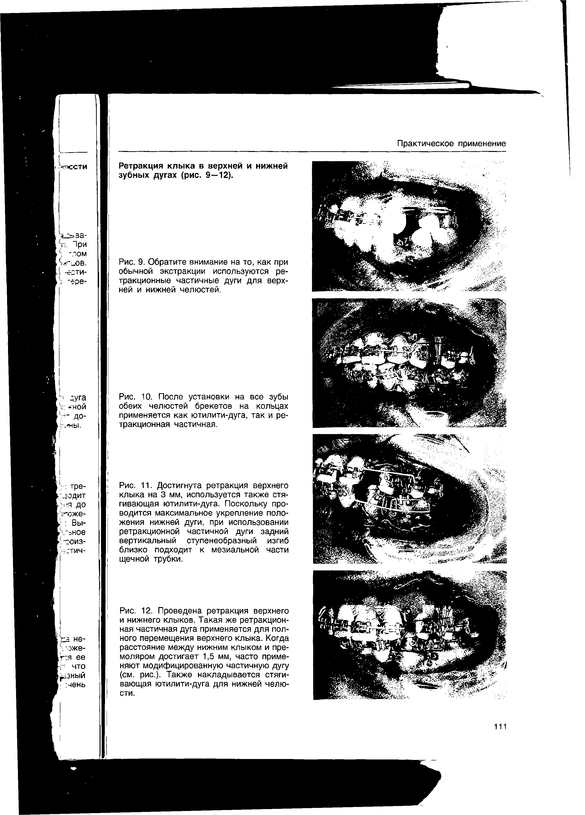 Рис. 11. Достигнута ретракция верхнего клыка на 3 мм, используется также стягивающая ютилити-дуга. Поскольку проводится максимальное укрепление положения нижней дуги, при использовании ретракционной частичной дуги задний вертикальный ступенеобразный изгиб близко подходит к мезиальной части щечной трубки.