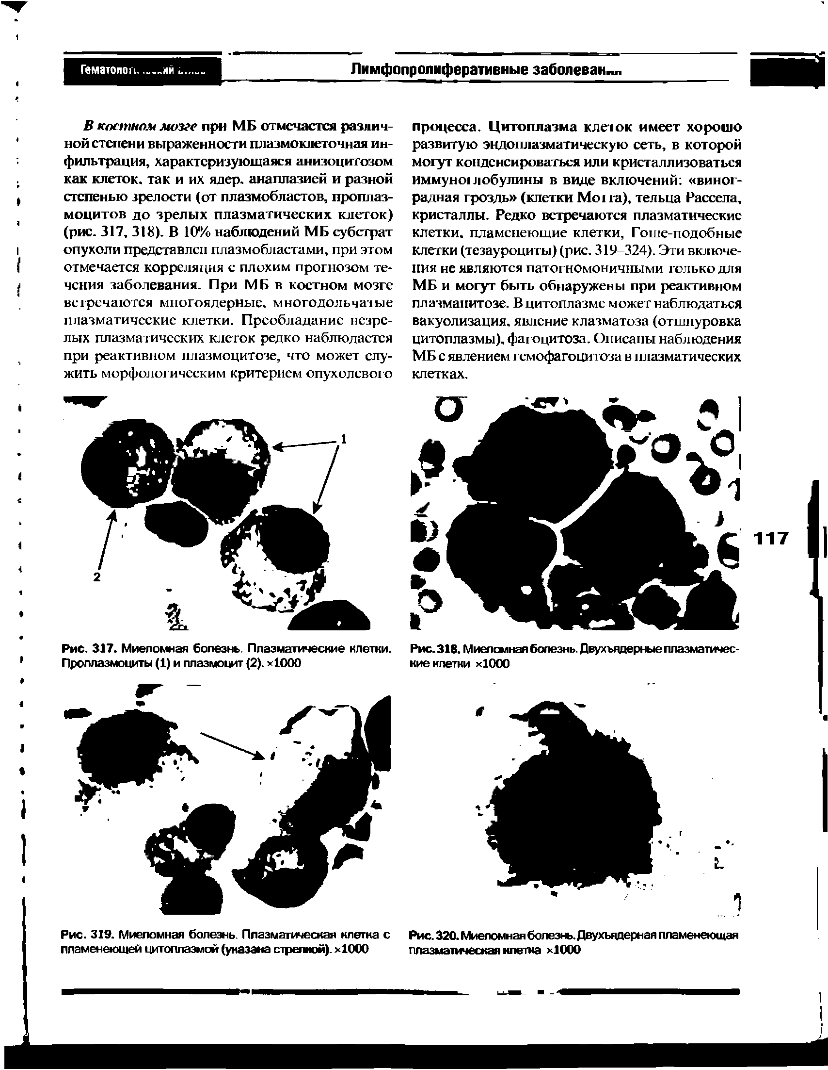 Рис. 317. Миеломная болезнь. Плазматические клетки. Проплазмоциты (1) и плазмоцит (2). >1000...