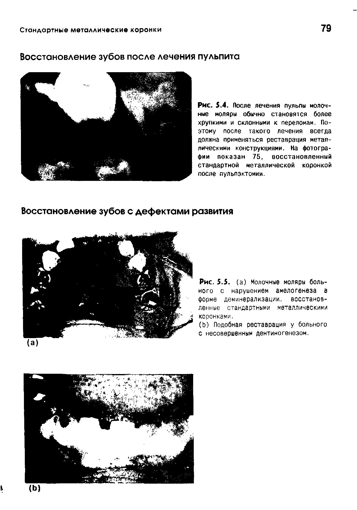 Рис. 5.4. После лечения пульпы молоч-ные моляры обычно становятся более хрупкими и склонными к переломам. Поэтому после такого лечения всегда должна применяться реставрация металлическими конструкциями. На фотографии показан 75, восстановленный стандартной металлической коронкой после пульлэктомии.