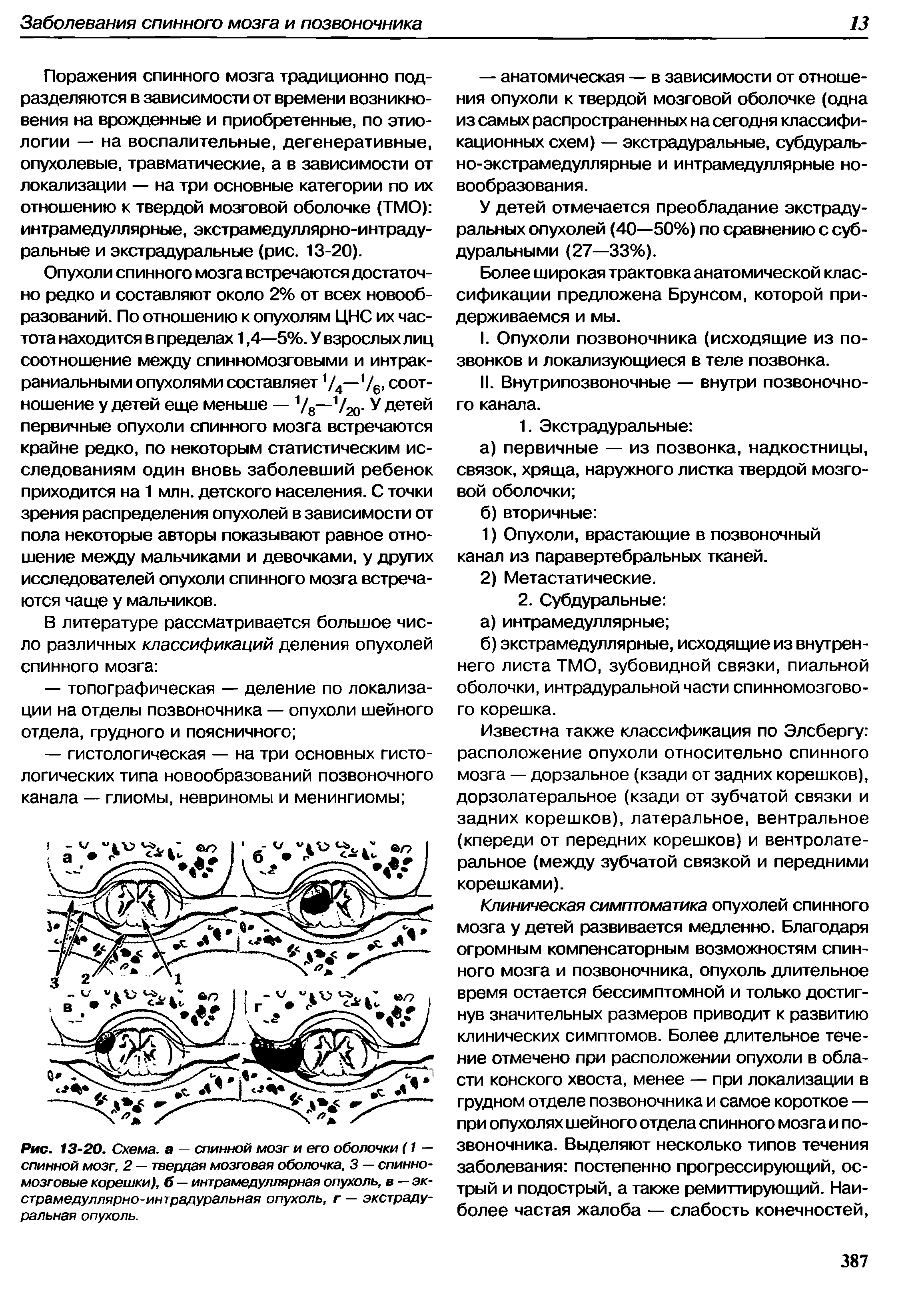 Рис. 13-20. Схема, а — спинной мозг и его оболочки (1 — спинной мозг, 2 — твердая мозговая оболочка, 3 — спинномозговые корешки), б — интрамедуллярная опухоль, в — экстрамедуллярно-интрадуральная опухоль, г — экстрадуральная опухоль.