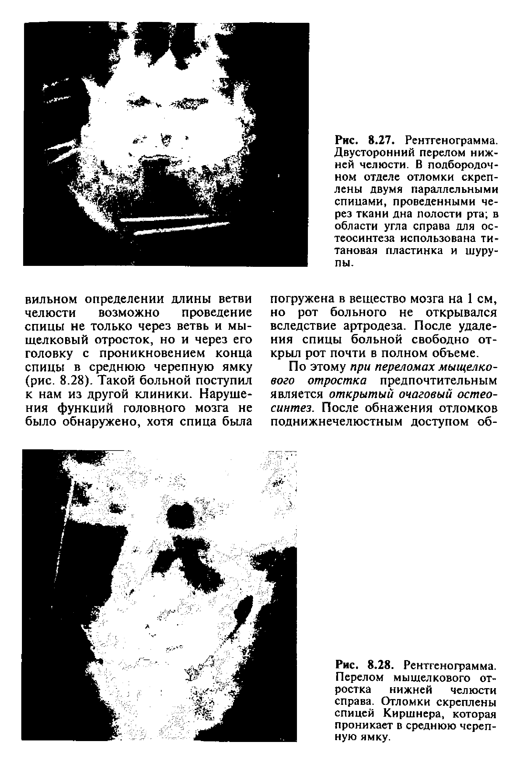 Рис. 8.28. Рентгенограмма. Перелом мыщелкового отростка нижней челюсти справа. Отломки скреплены спицей Киршнера, которая проникает в среднюю черепную ямку.