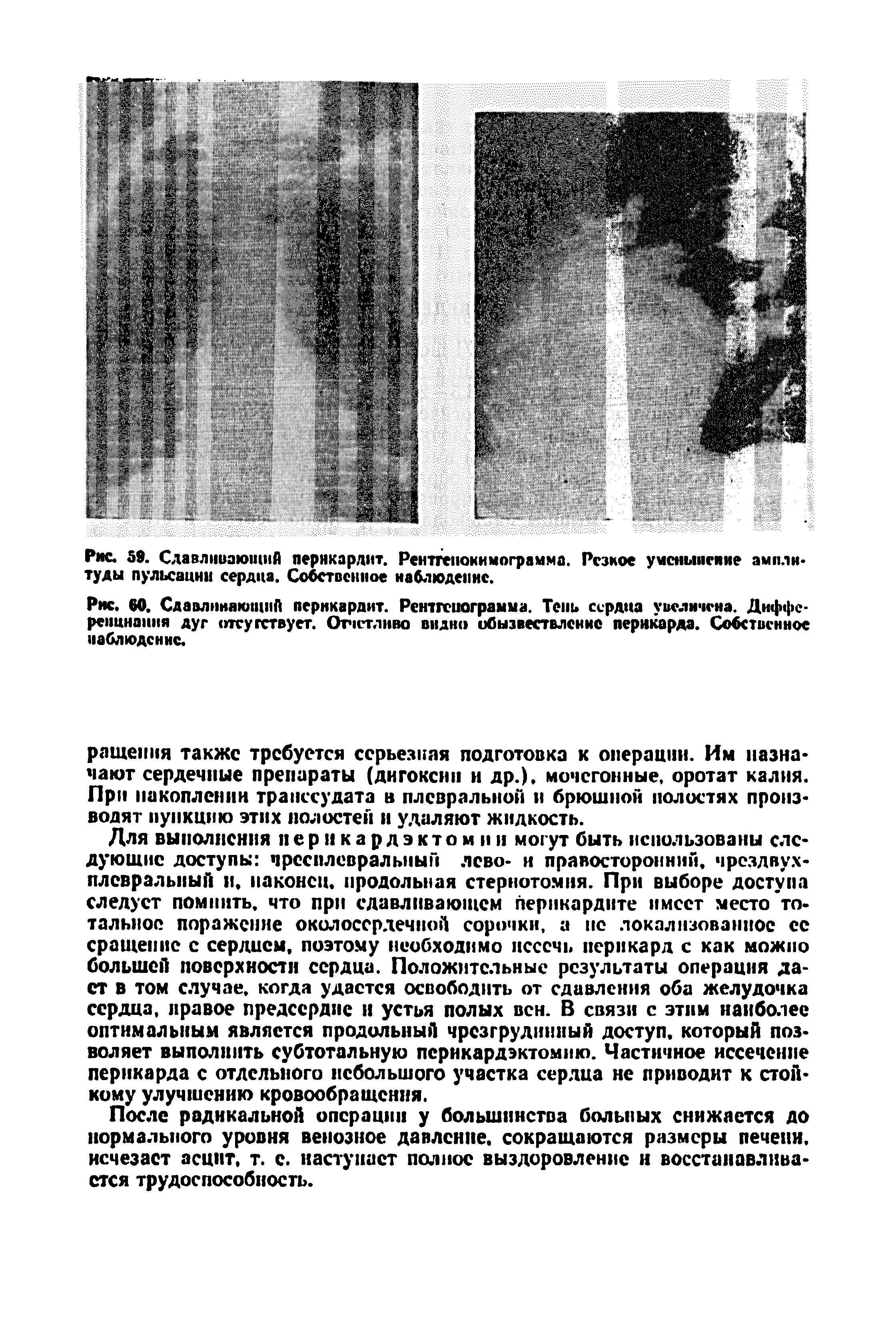 Рис. 60. Сдавлннающнй перикардит. Рентгенограмма. Тень сердца увеличена. Дифференциация дуг отсутствует. Отчетливо видно обызвествление перикарда. Собственное наблюдение.