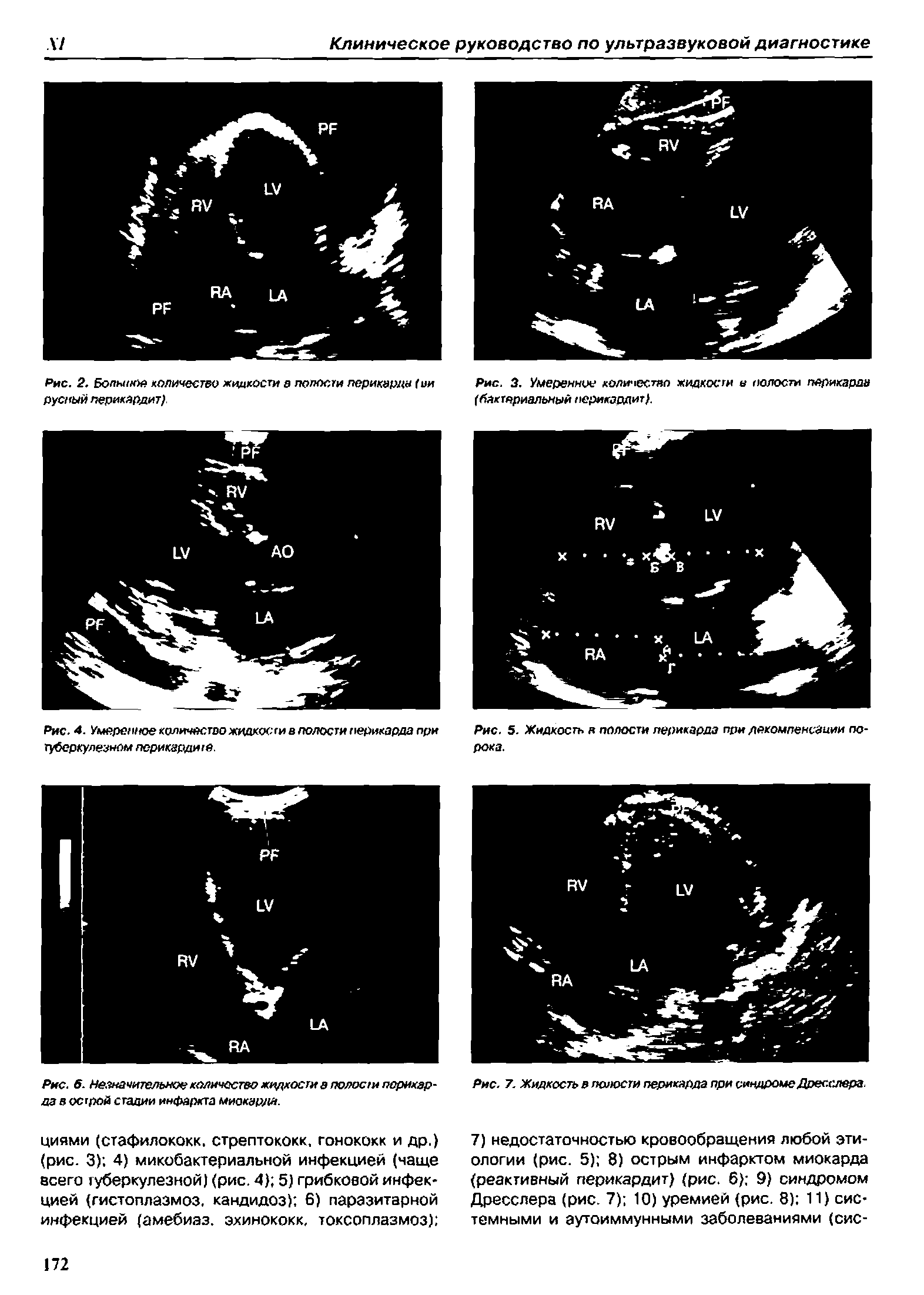 Рис. 4. Умеренное количество жидкости в полости перикарда при туберкулезном перикардию.