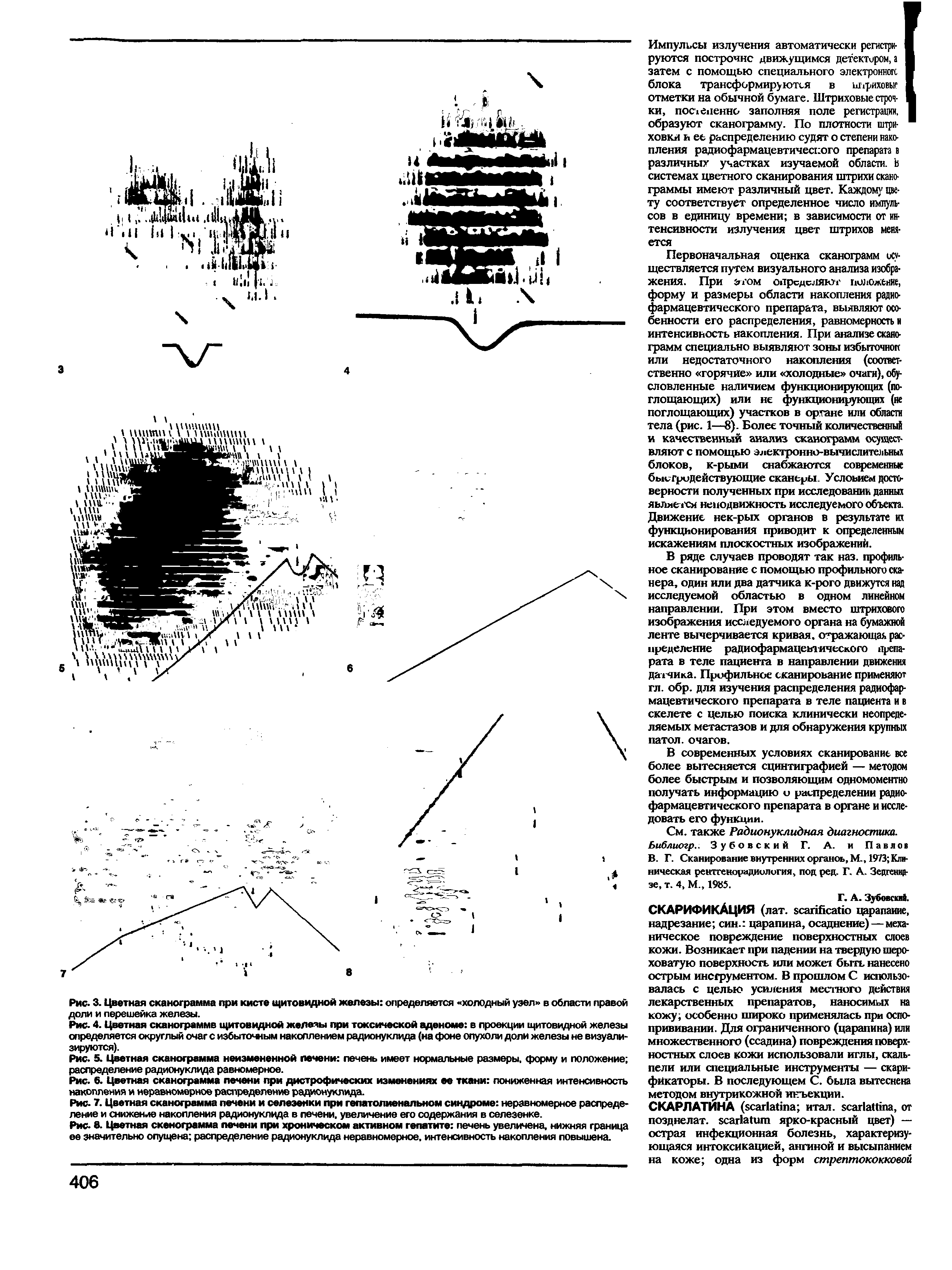 Рис. 4. Цветная сканограмме щитовидной железы при токсической аденоме в проекции щитовидной железы определяется округлый очаг с избыточным накоплением радионуклида (на фоне опухоли доли железы не визуализируются).