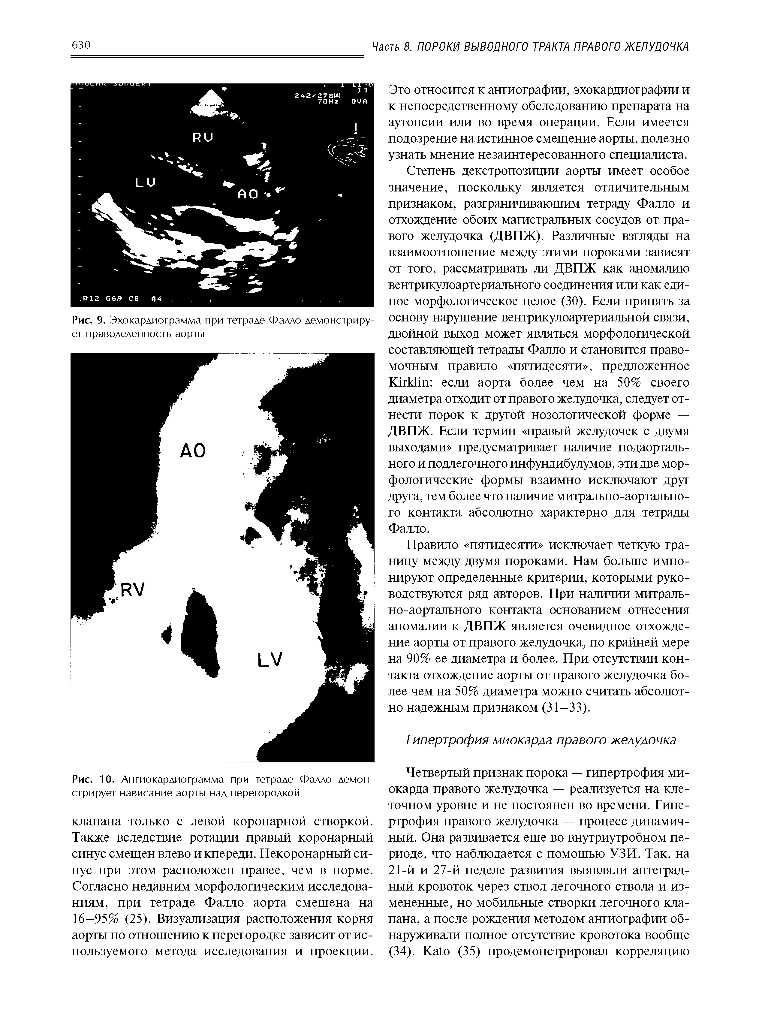 Рис. 9. Эхокардиограмма при тетраде Фалло демонстрирует праводеленность аорты...