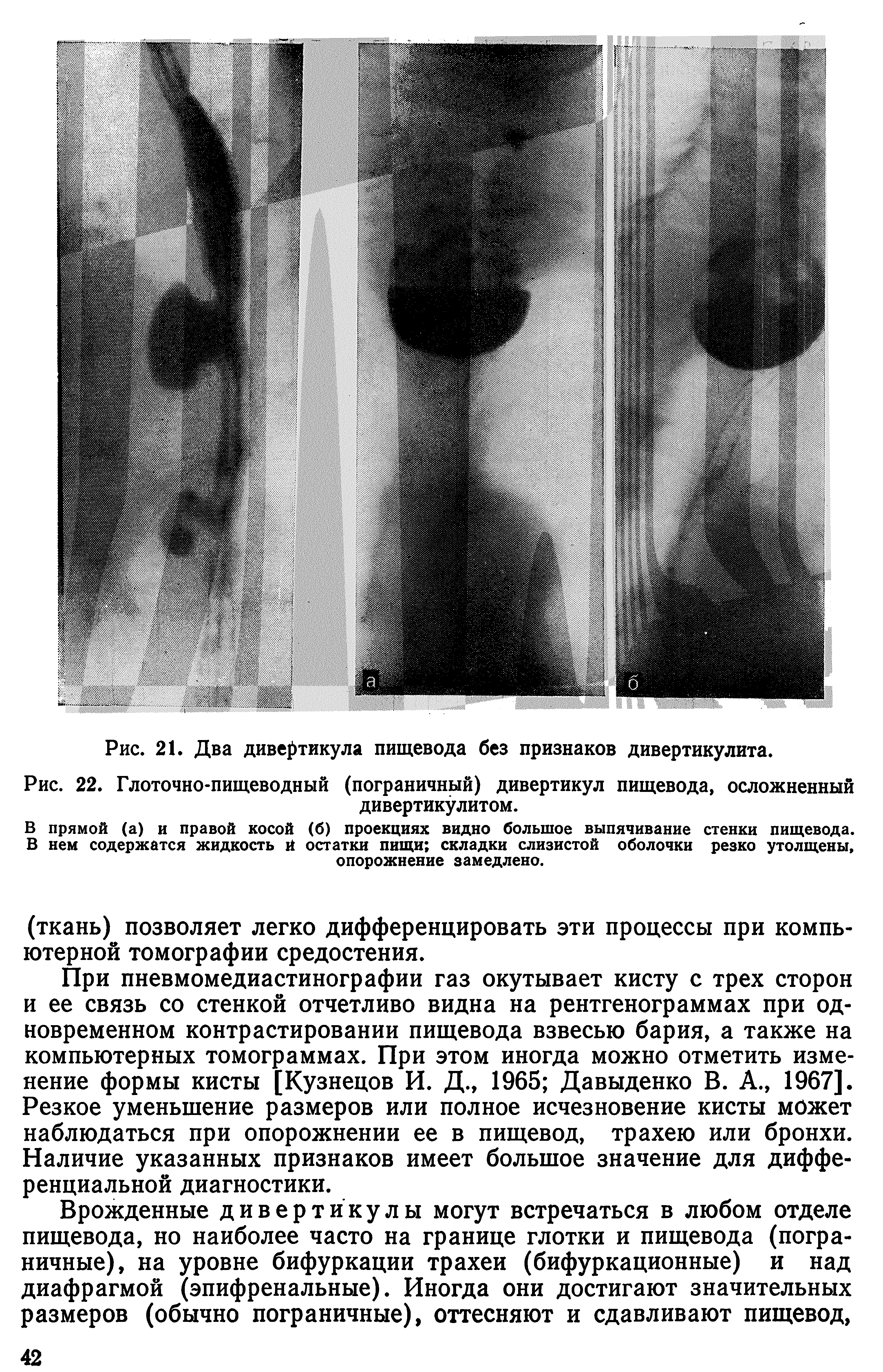 Рис. 22. Глоточно-пищеводный (пограничный) дивертикул пищевода, осложненный дивертикулитом.