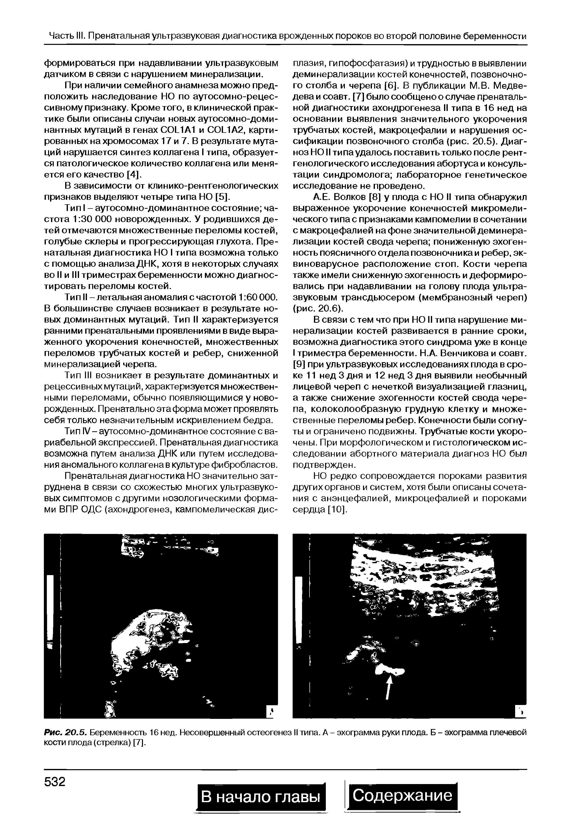 Рис. 20.5. Беременность 16 нед. Несовершенный остеогенез II типа. А - эхограмма руки плода. Б - эхограмма плечевой кости плода (стрелка) [7].