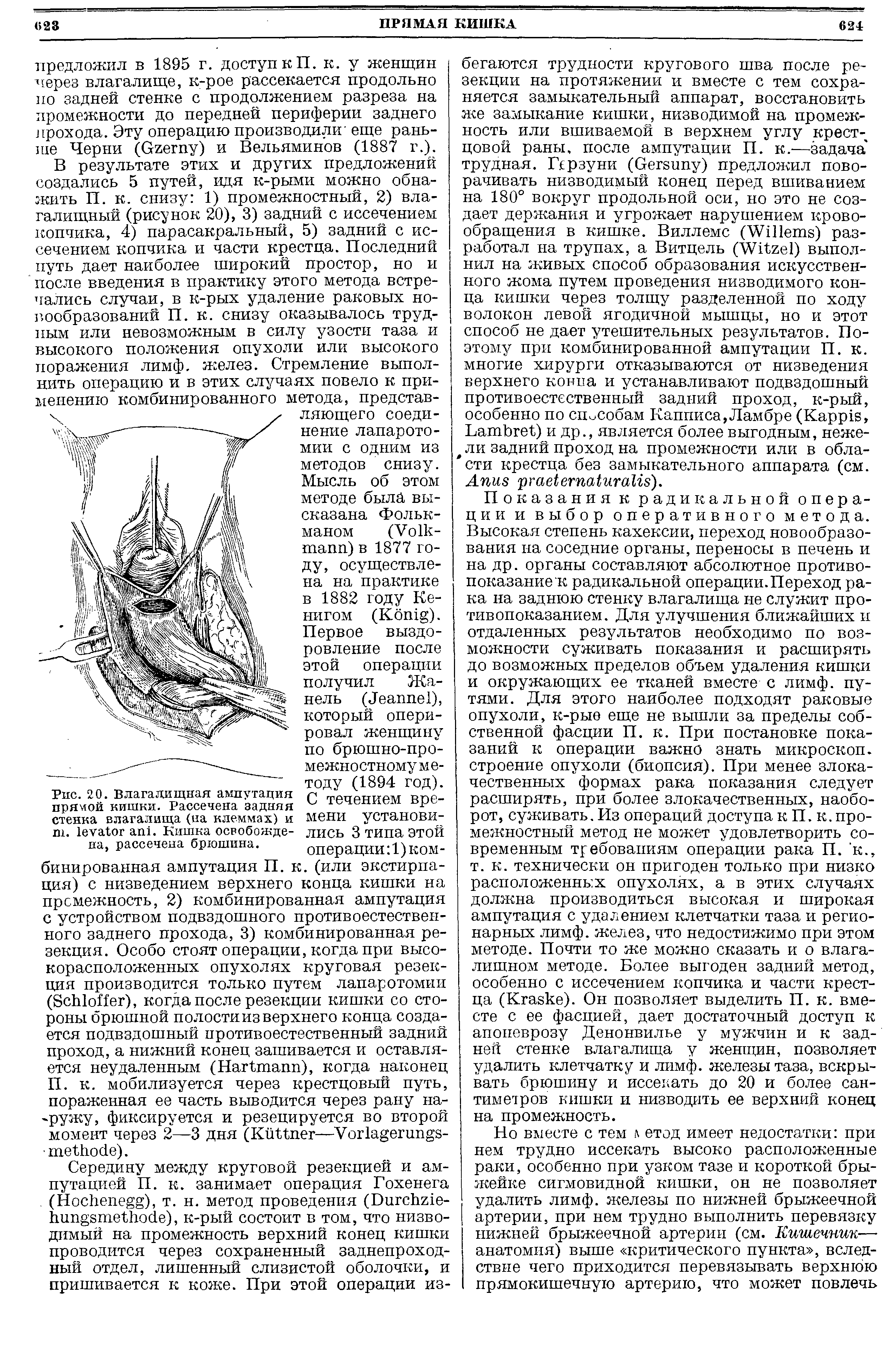 Рис. 20. Влагалищная ампутация пряной кишки. Рассечена задняя стенка влагалища (на клеммах) и ш. . Кишка освобождена, рассечена брюшина.