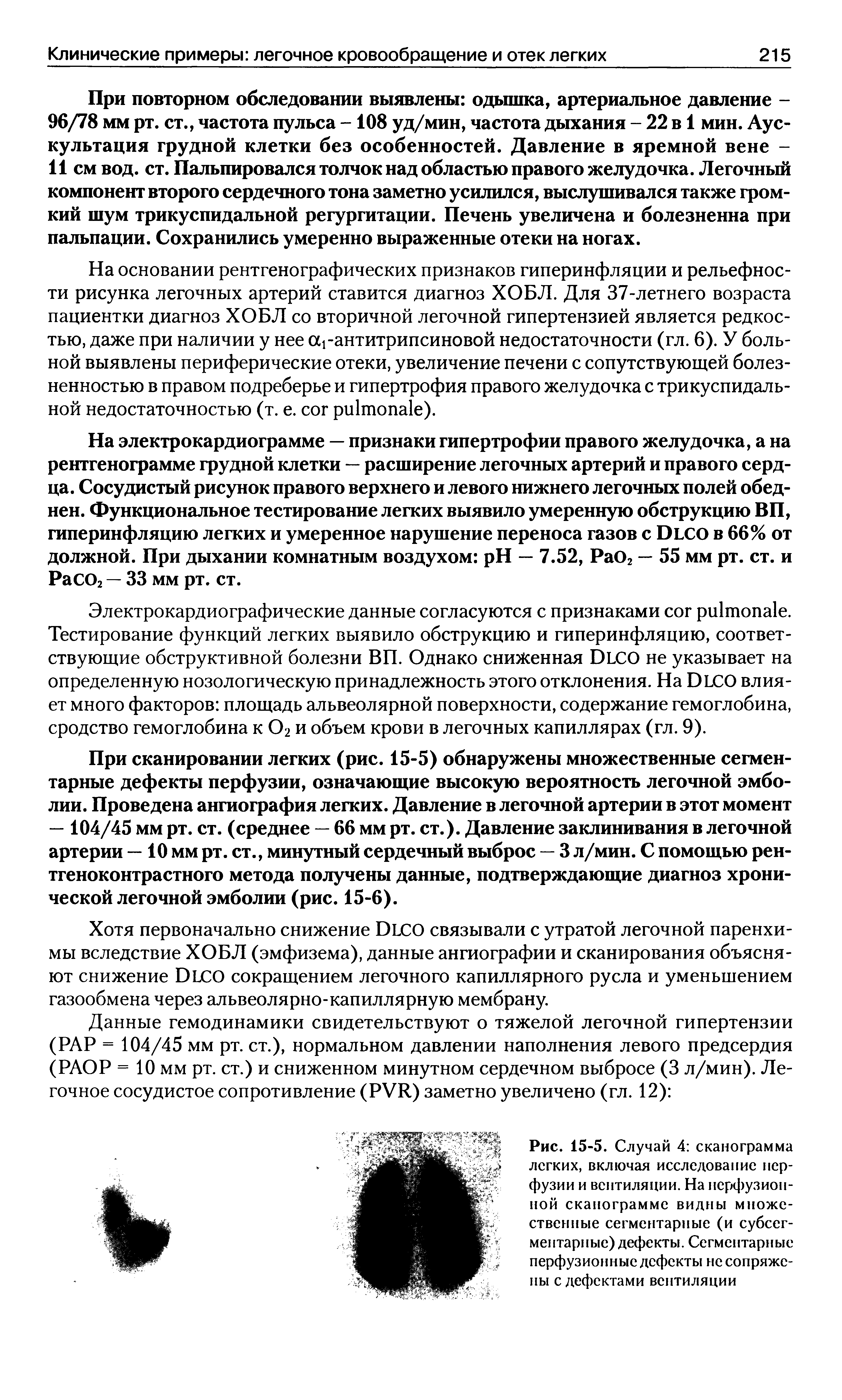 Рис. 15-5. Случай 4 сканограмма легких, включая исследование перфузии и вентиляции. На перфузионной сканограмме видны множественные сегментарные (и субсегментарные) дефекты. Сегментарные перфузионные дефекты нс сопряжены с дефектами вентиляции...