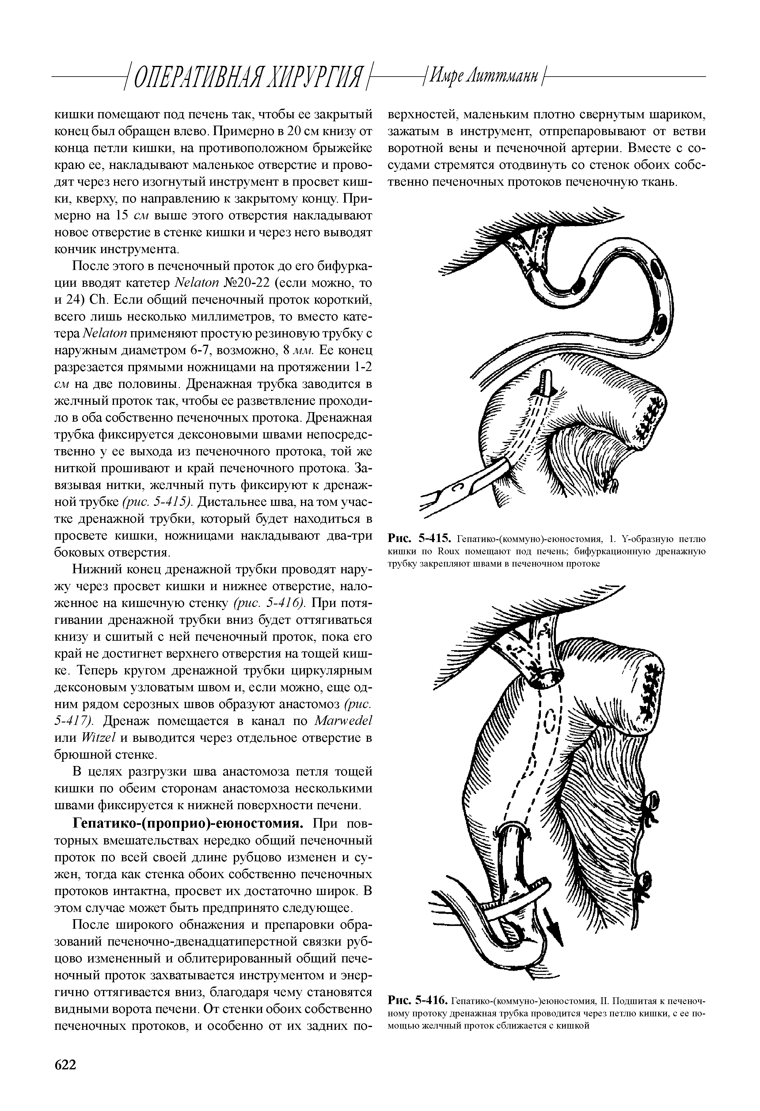 Рис. 5-416. Гепатико-(коммуно-)еюностомия, II. Подшитая к печеночному протоку дренажная трубка проводится через петлю кишки, с ее помощью желчный проток сближается с кишкой...