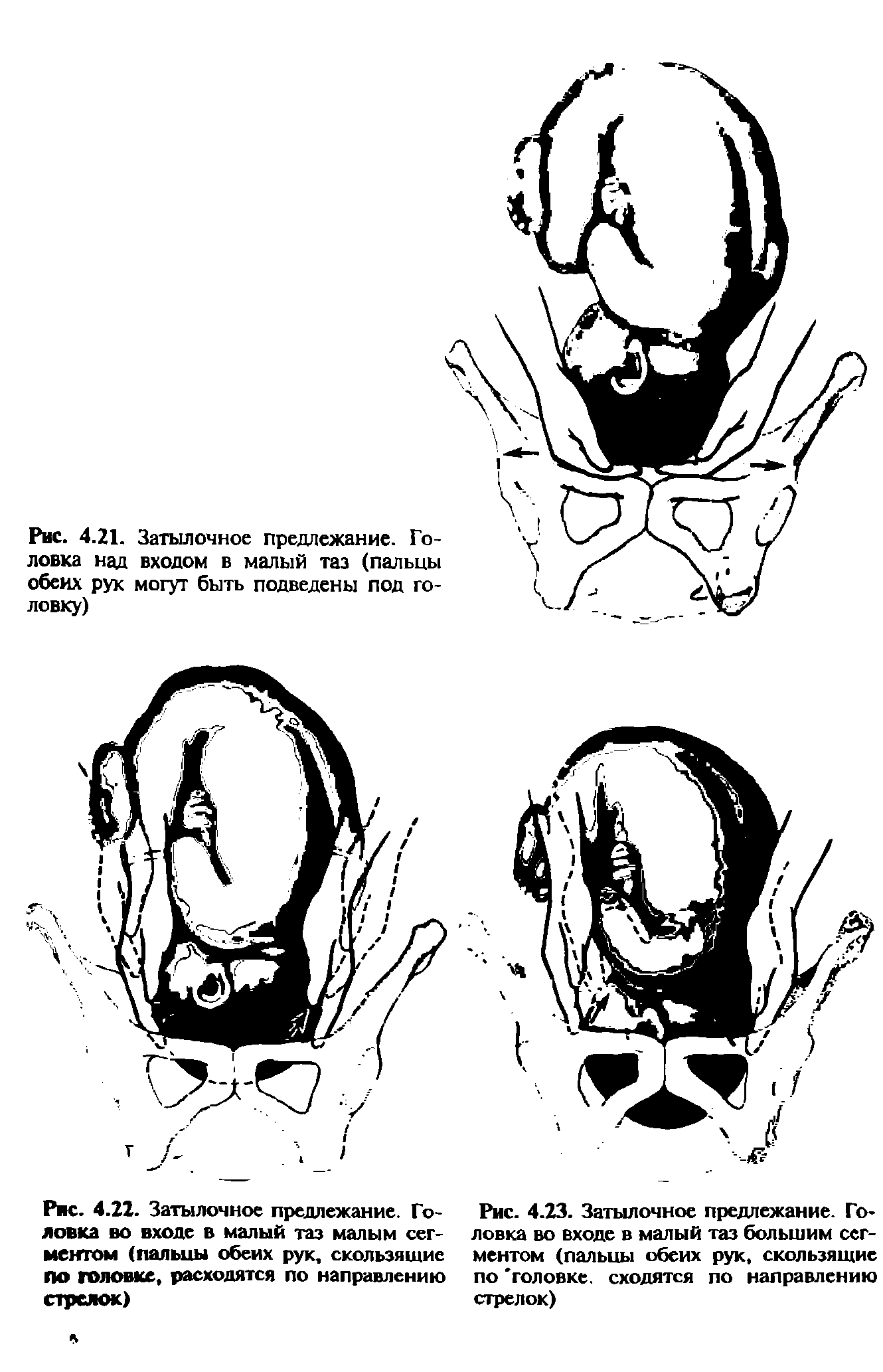 Рис. 4.23. Затылочное предлежание. Головка во входе в малый таз большим сегментом (пальцы обеих рук, скользящие по головке, сходятся по направлению стрелок)...