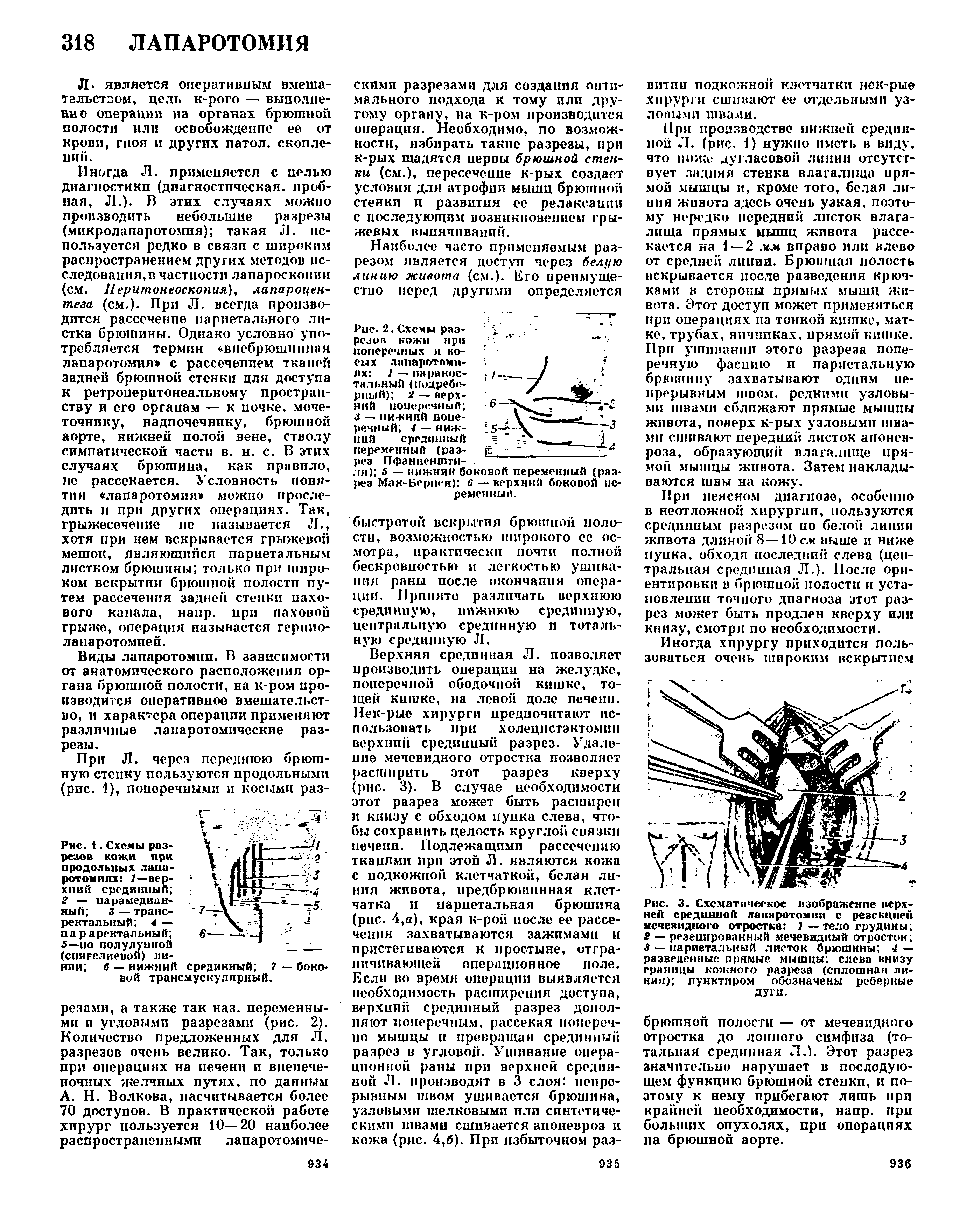 Рис. 1. Схемы разрезов кожи при продольных лапаротомиях I—верхний срединный 2 — парамедианный 3 — трансректальный 4 — пар аректальный 5—по полулунной (спигелиевой) ли-...