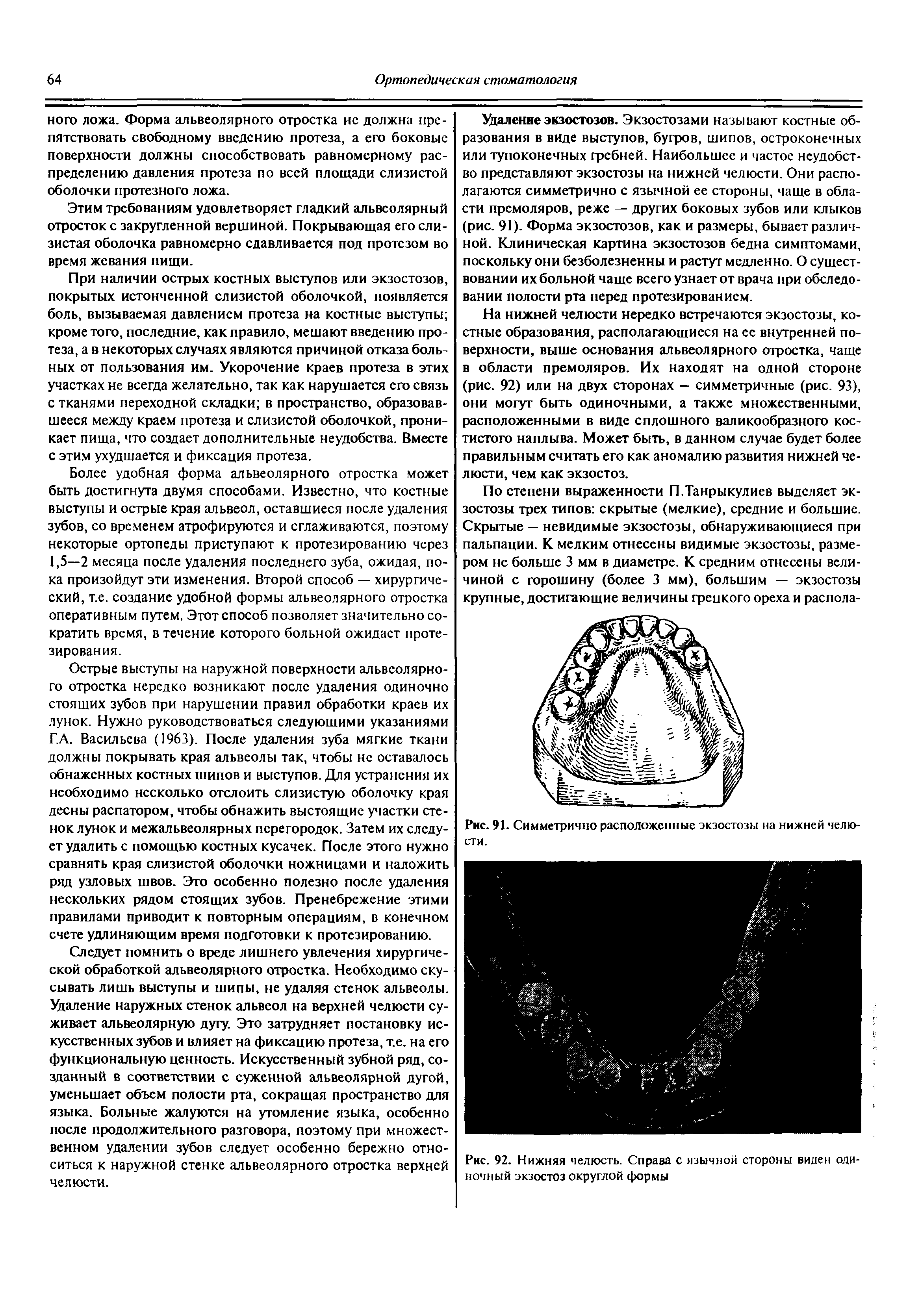 Рис. 92. Нижняя челюсть. Справа с язычной стороны виден одиночный экзостоз округлой формы...