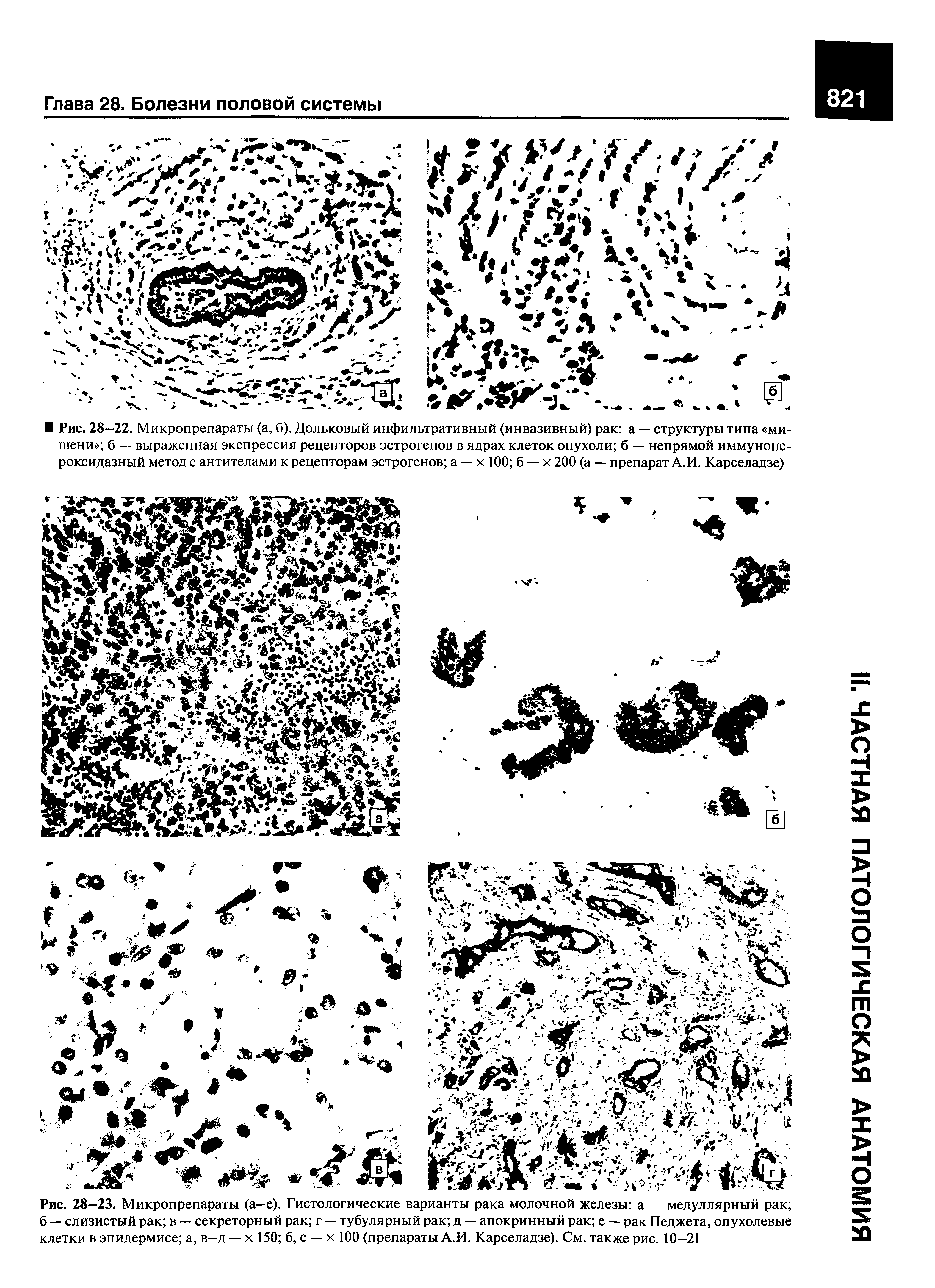 Рис. 28—23. Микропрепараты (а—е). Гистологические варианты рака молочной железы а — медуллярный рак б — слизистый рак в — секреторный рак г — тубулярный рак д — апокринный рак е — рак Педжета, опухолевые клетки в эпидермисе а, в-д — х 150 б, е — х 100 (препараты А.И. Карселадзе). См. также рис. 10-21...