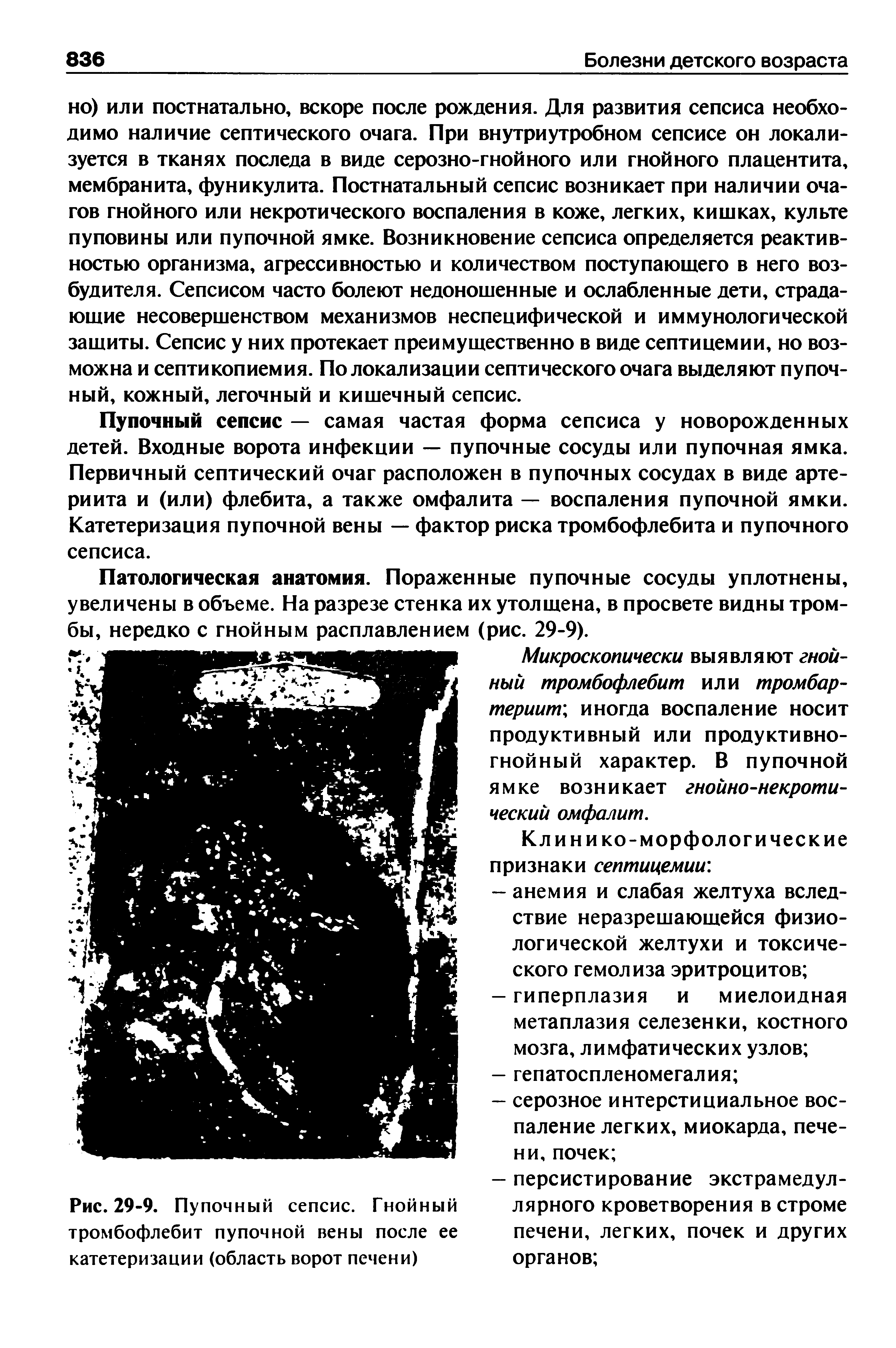 Рис. 29-9. Пупочный сепсис. Гнойный тромбофлебит пупочной вены после ее катетеризации (область ворот печени)...