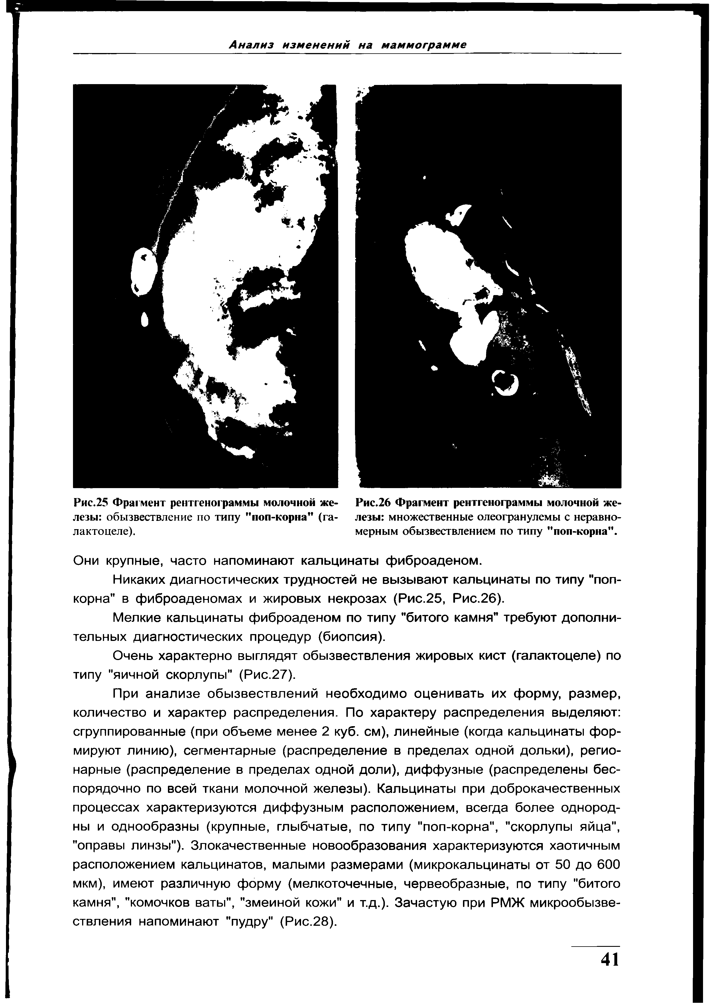 Рис.26 Фрагмент рентгенограммы молочной железы множественные олеогранулемы с неравномерным обызвествлением по типу "поп-корна".