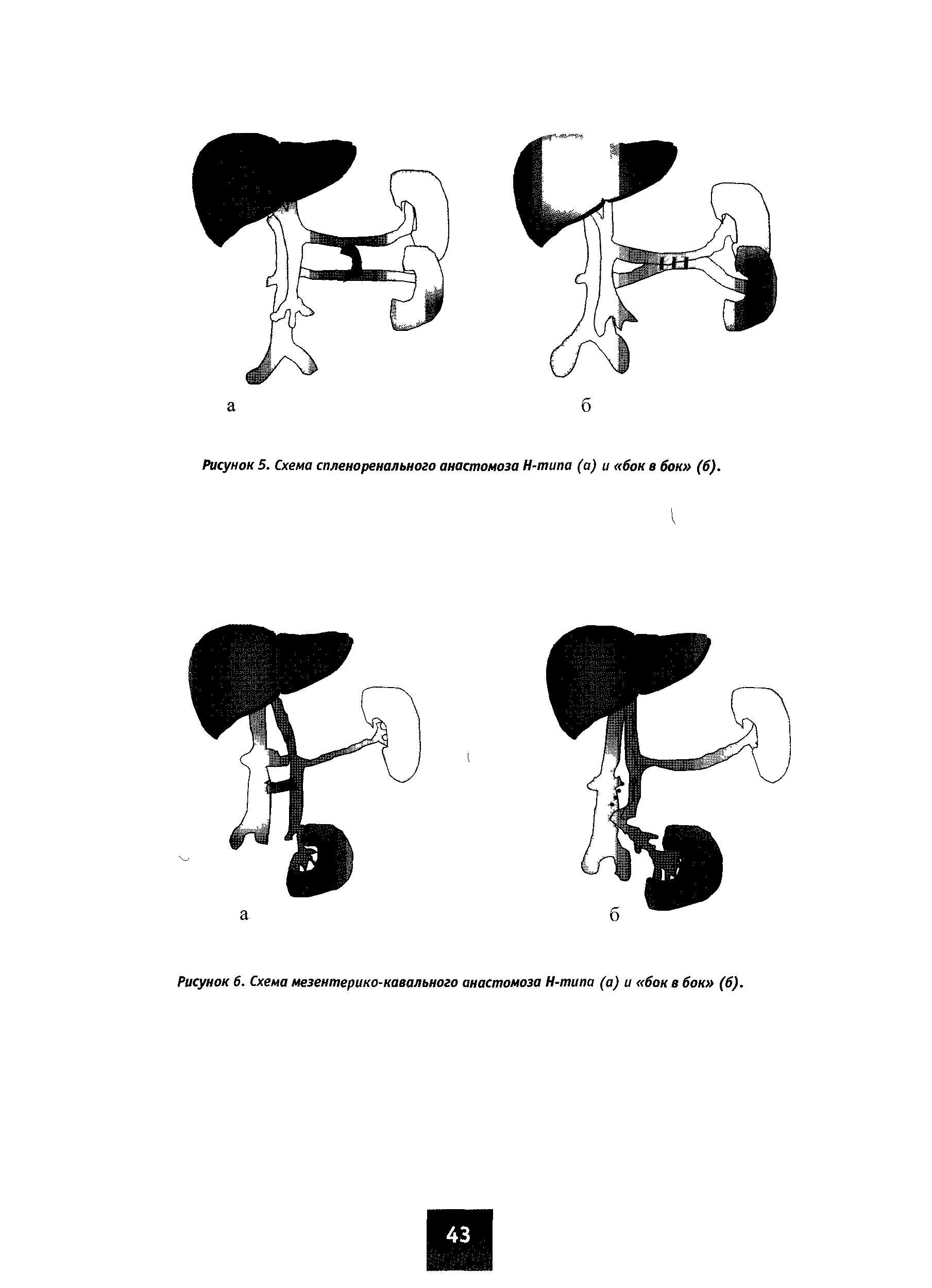 Рисунок 6. Схема мезентерико-кавального анастомоза Н-типа (а) и бок в бок (б).