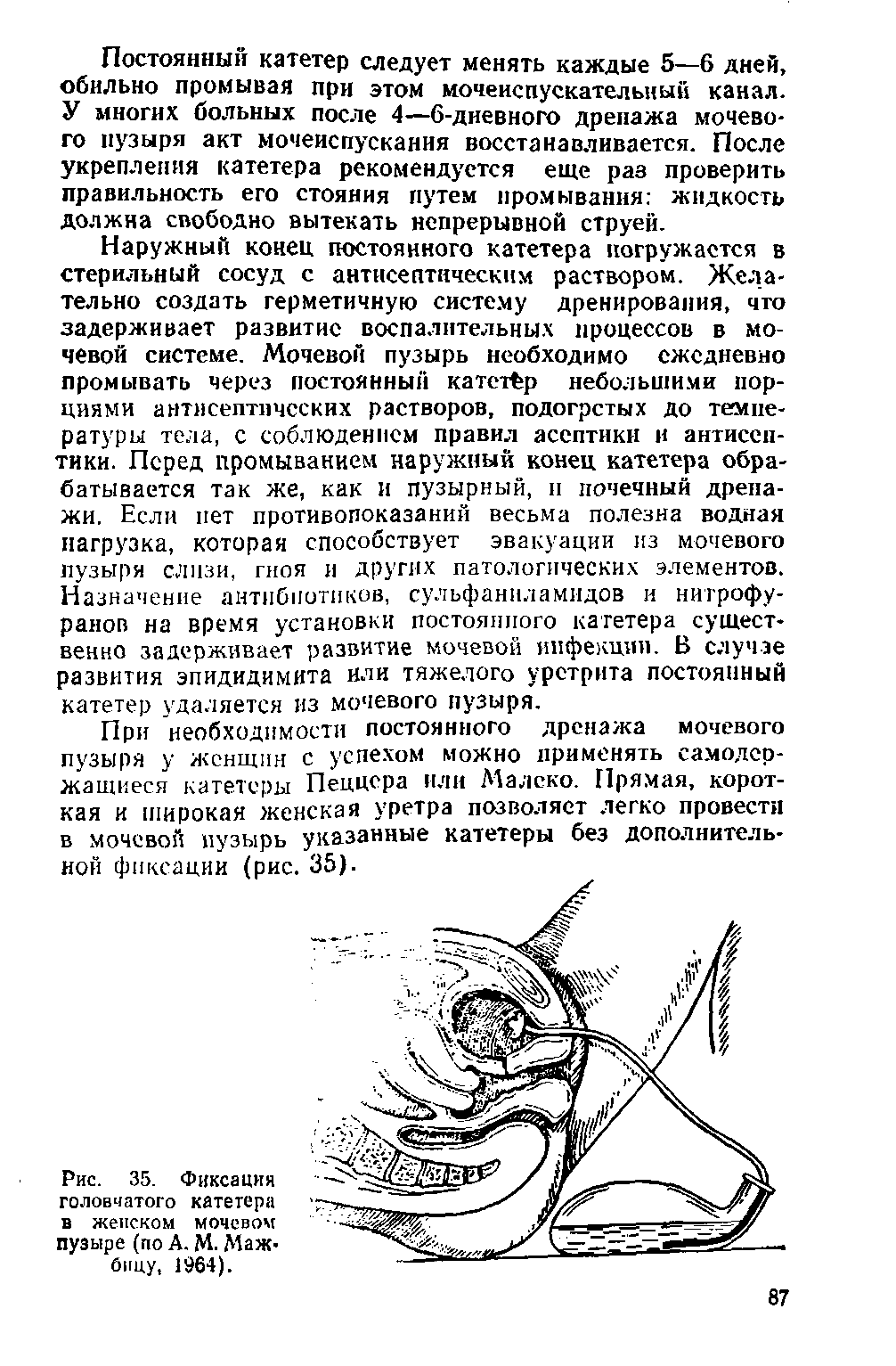 Рис. 35. Фиксация головчатого катетера в женском мочевом пузыре (по А. М. Маж> Вицу, 1964).