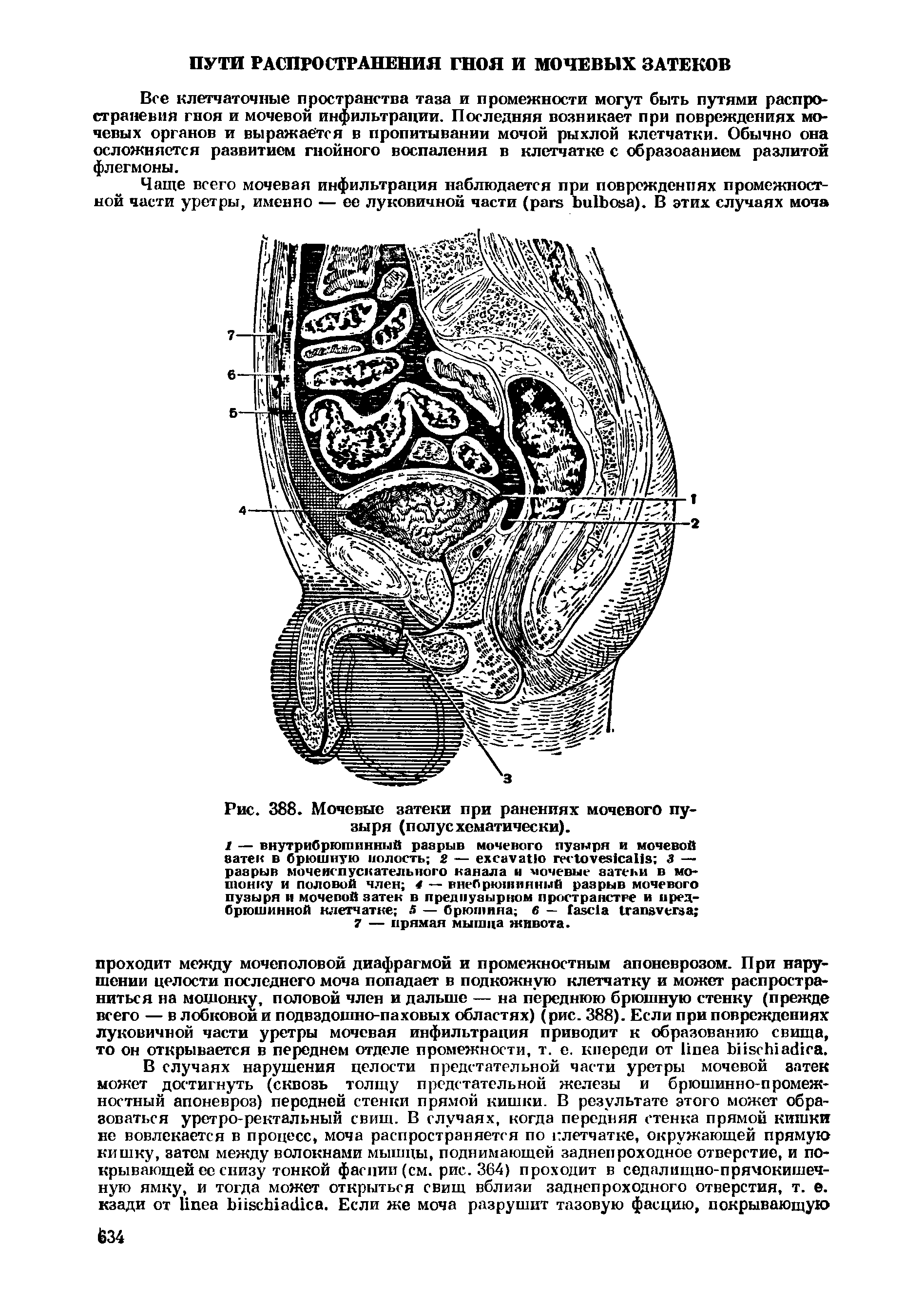Рис. 388. Мочевые затеки при ранениях мочевого пузыря (полусхематически).