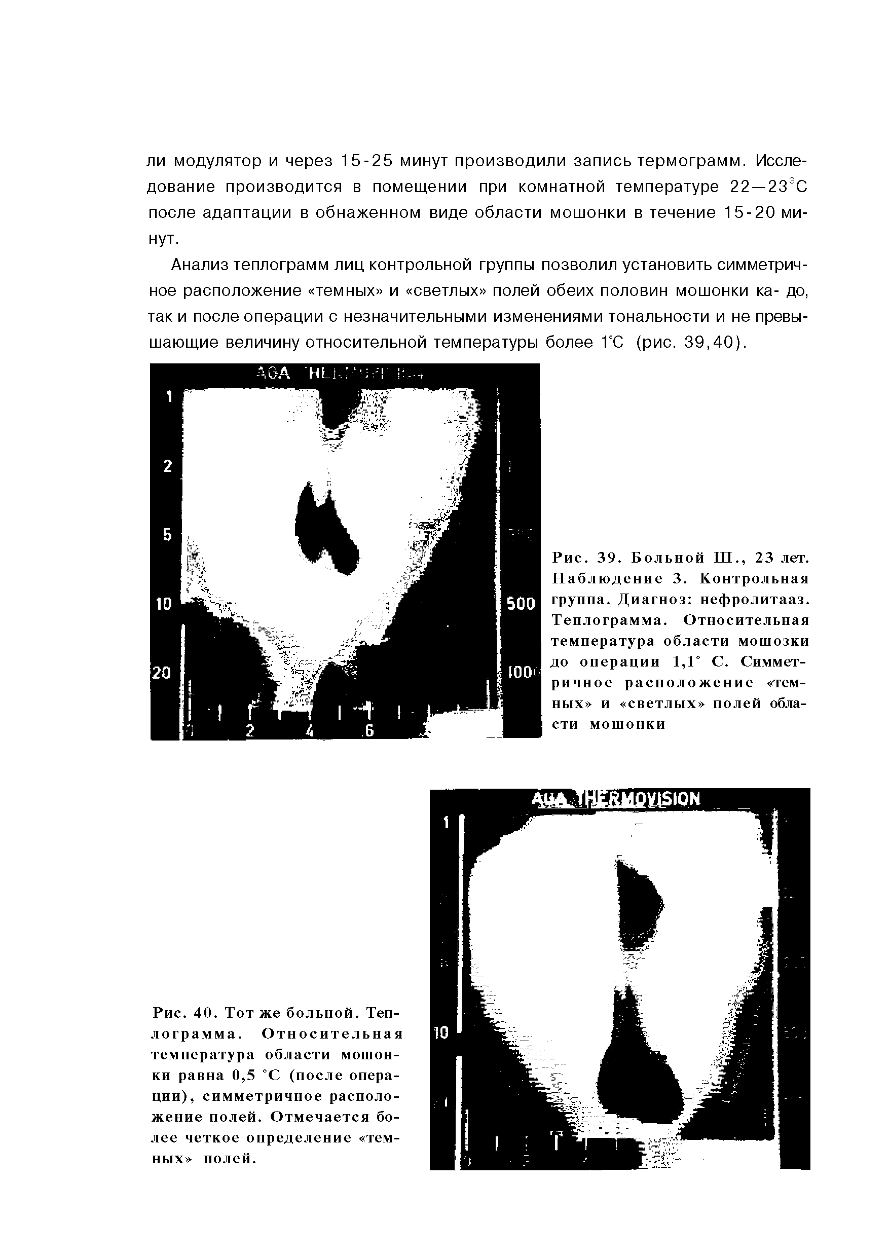Рис. 40. Тот же больной. Теплограмма. Относительная температура области мошонки равна 0,5 °С (после операции), симметричное расположение полей. Отмечается более четкое определение темных полей.