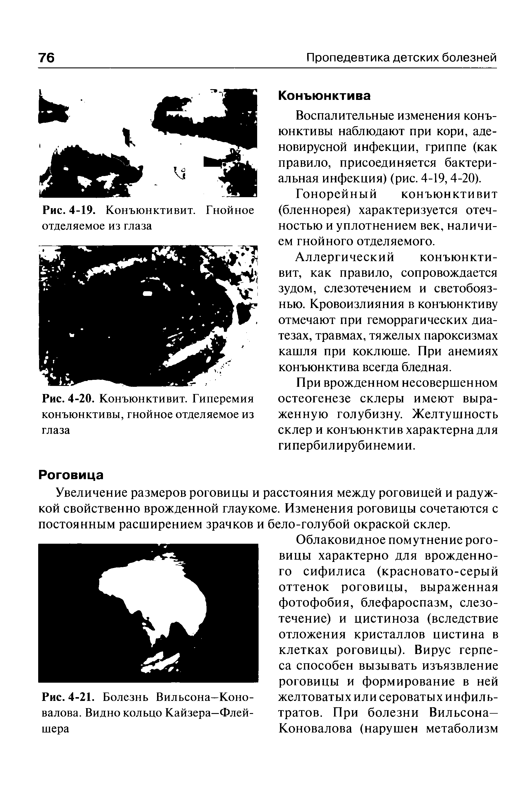 Рис. 4-20. Конъюнктивит. Гиперемия конъюнктивы, гнойное отделяемое из глаза...