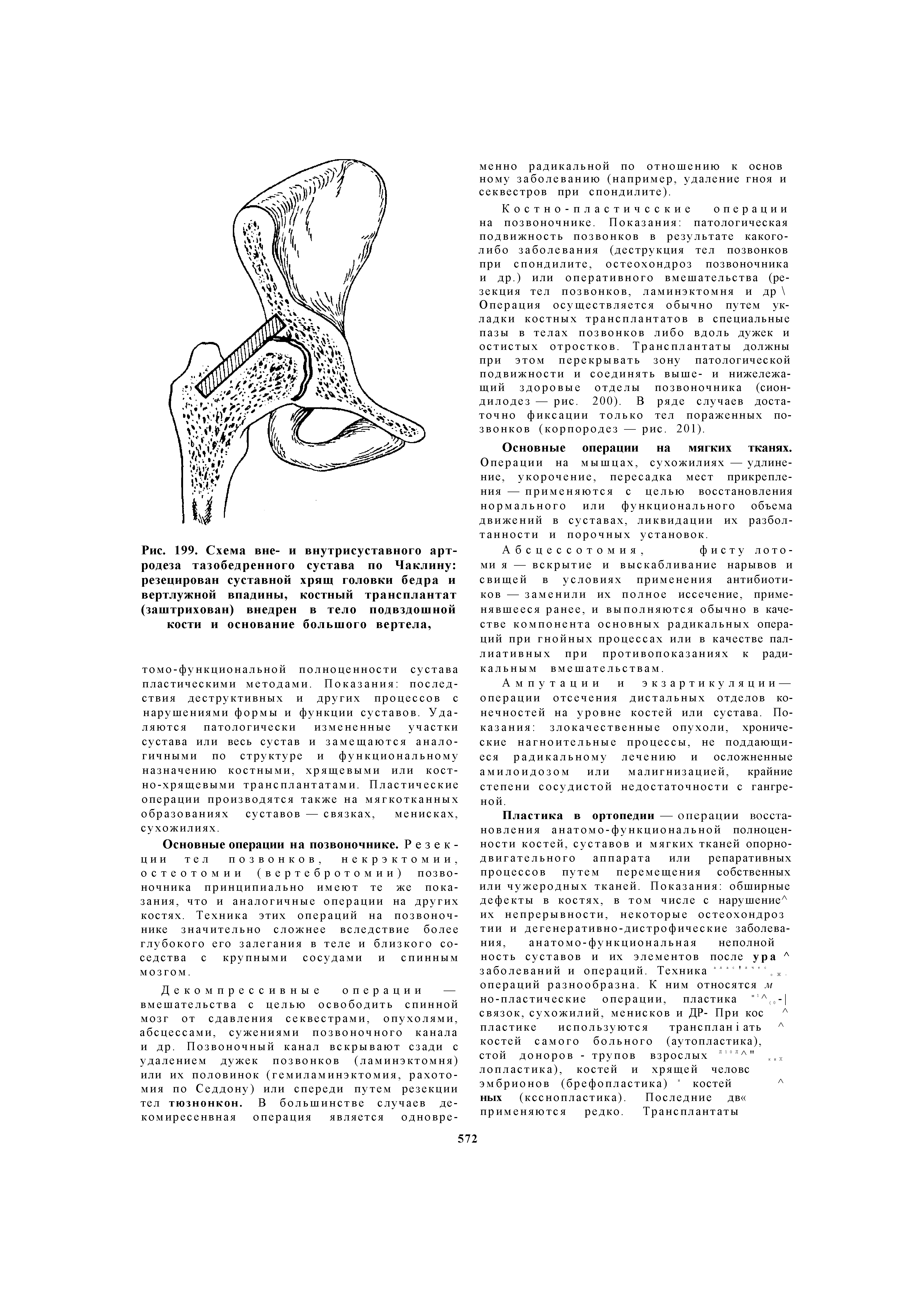 Рис. 199. Схема вне- и родеза тазобедренного резецирован суставной вертлужной впадины, (заштрихован) внедрен кости и основание...