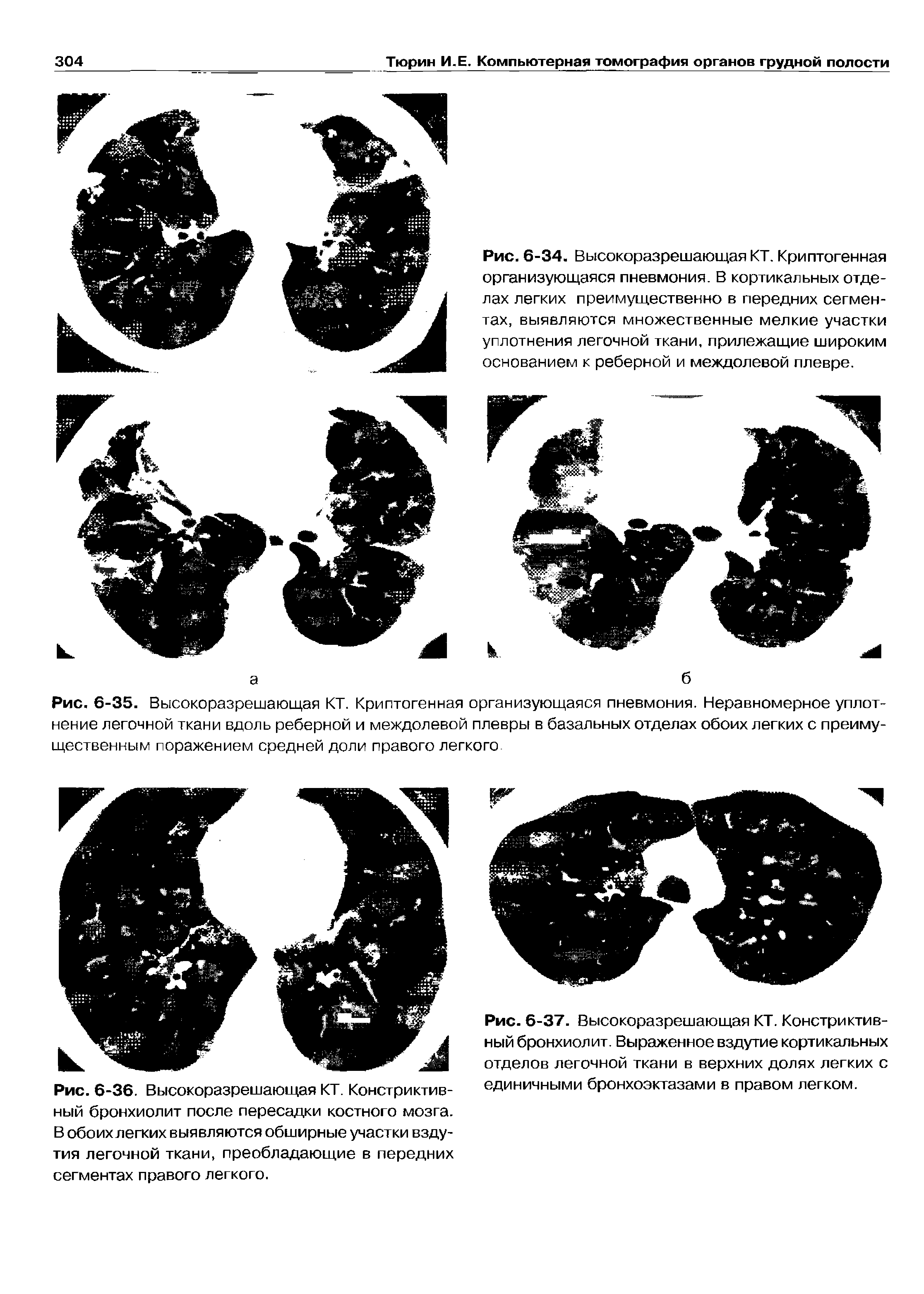 Рис. 6-34. Высокоразрешающая КТ. Криптогенная организующаяся пневмония. В кортикальных отделах легких преимущественно в передних сегментах, выявляются множественные мелкие участки уплотнения легочной ткани, прилежащие широким основанием к реберной и междолевой плевре.