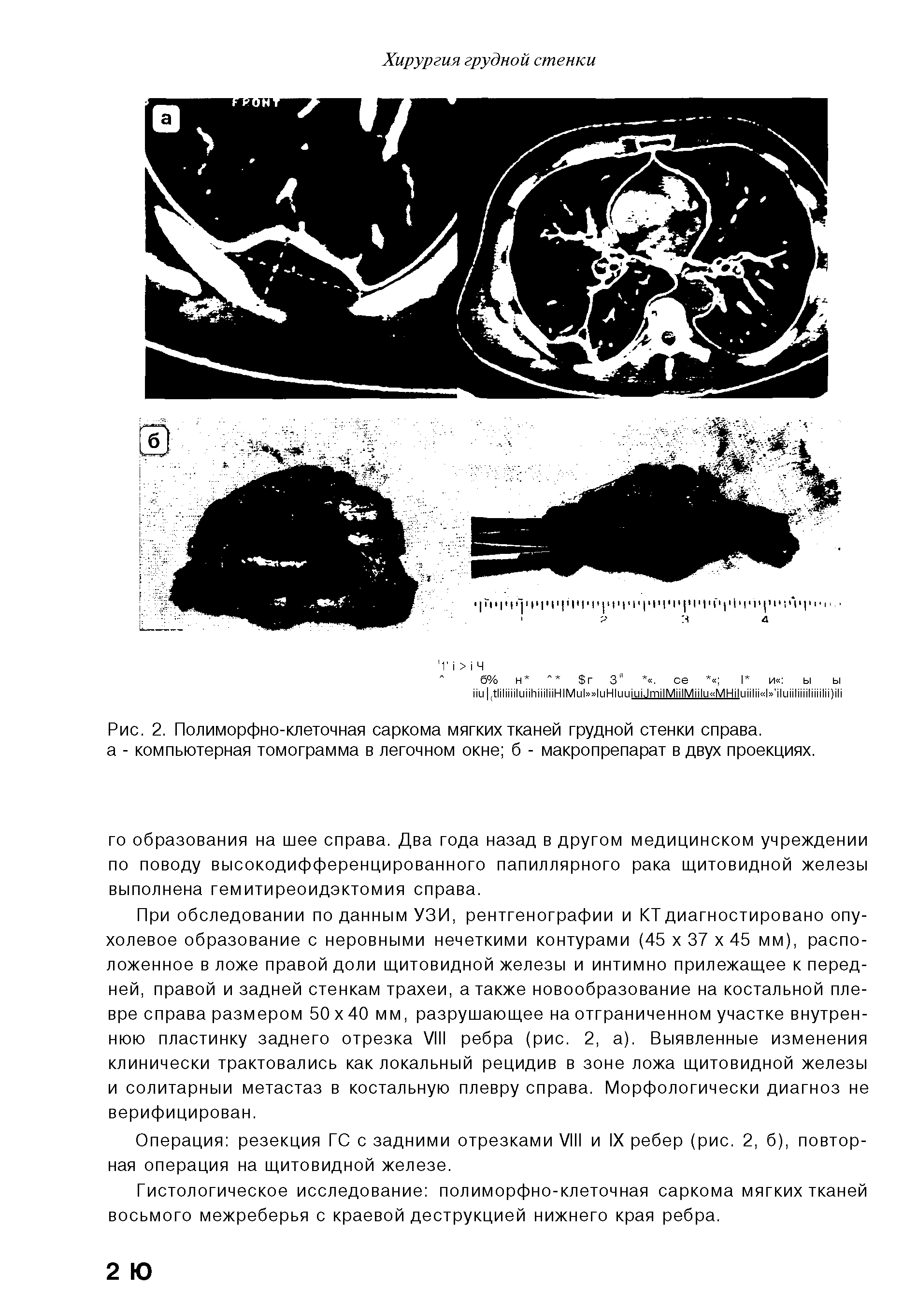 Рис. 2. Полиморфно-клеточная саркома мягких тканей грудной стенки справа, а - компьютерная томограмма в легочном окне б - макропрепарат в двух проекциях.