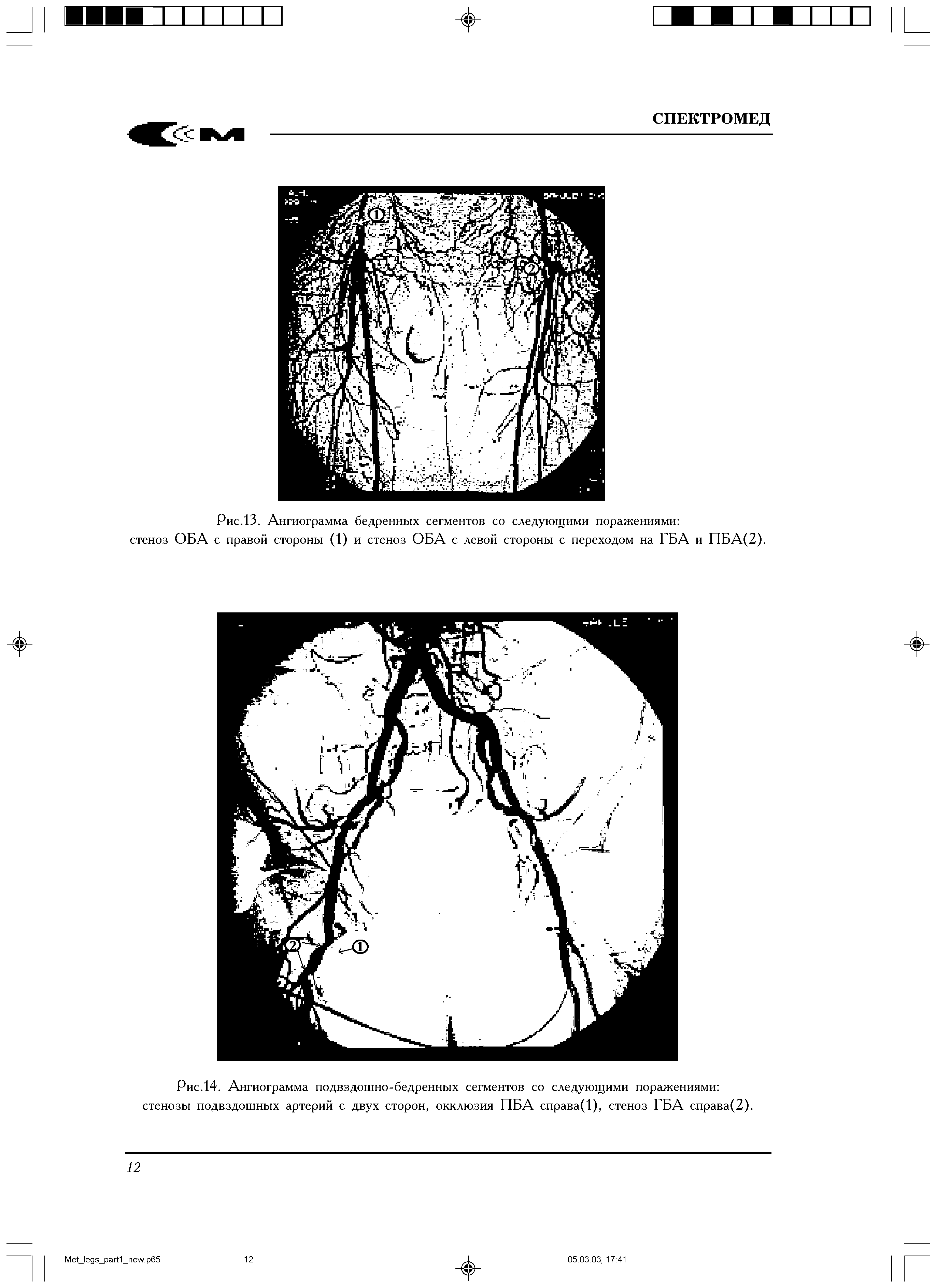 Рис.14. Ангиограмма подвздошно-бедренных сегментов со следующими поражениями стенозы подвздошных артерий с двух сторон, окклюзия ПБА справа(1), стеноз ГБА справа(2).