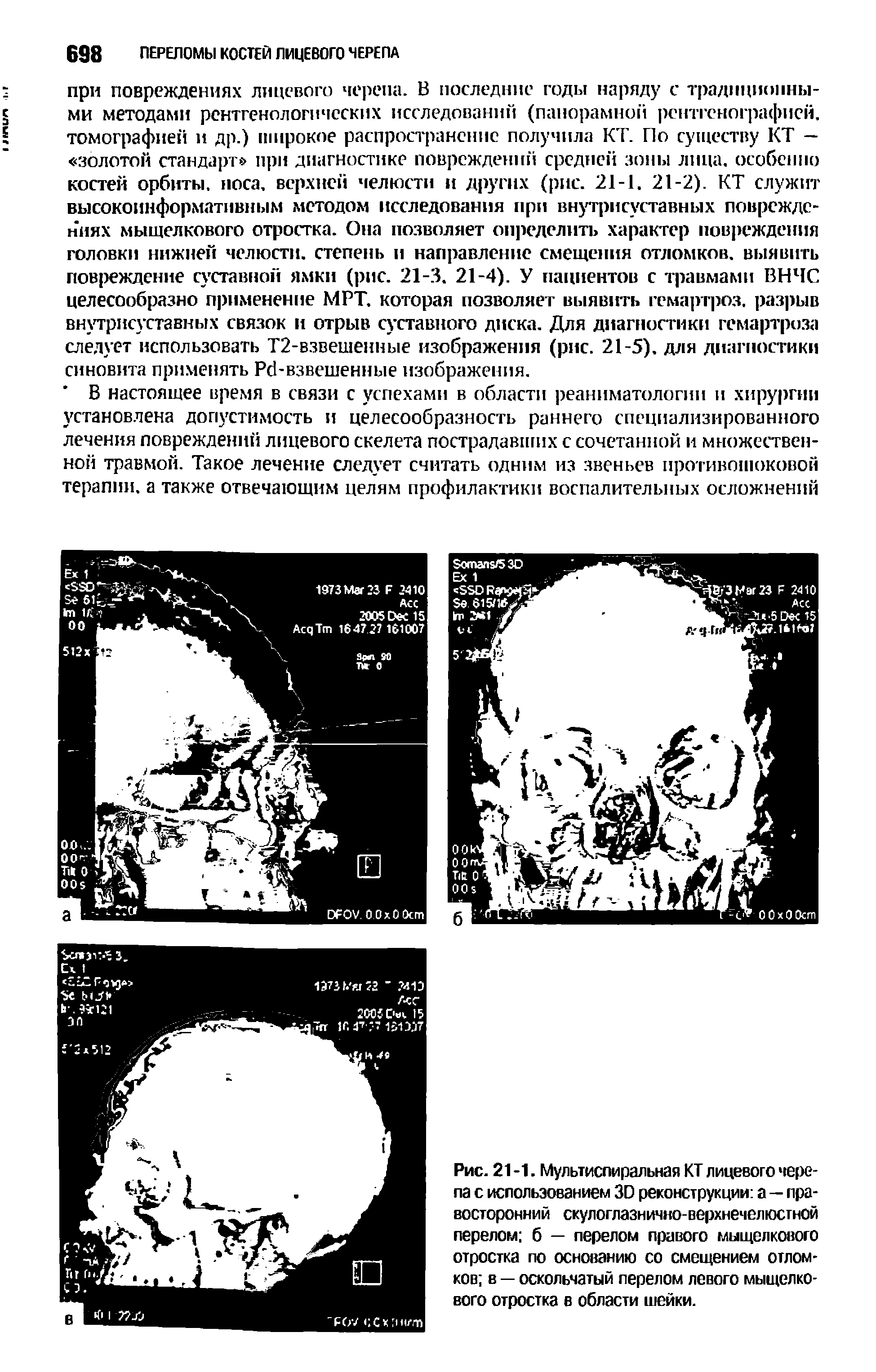 Рис. 21 -1. Мультиспиральная КТ лицевого черепа с использованием 30 реконструкции а—правосторонний скулоглазнично-верхнечелюстной перелом б — перелом правого мыщелкового отростка по основанию со смещением отломков в — оскольчатый перелом левого мыщелкового отростка в области шейки.