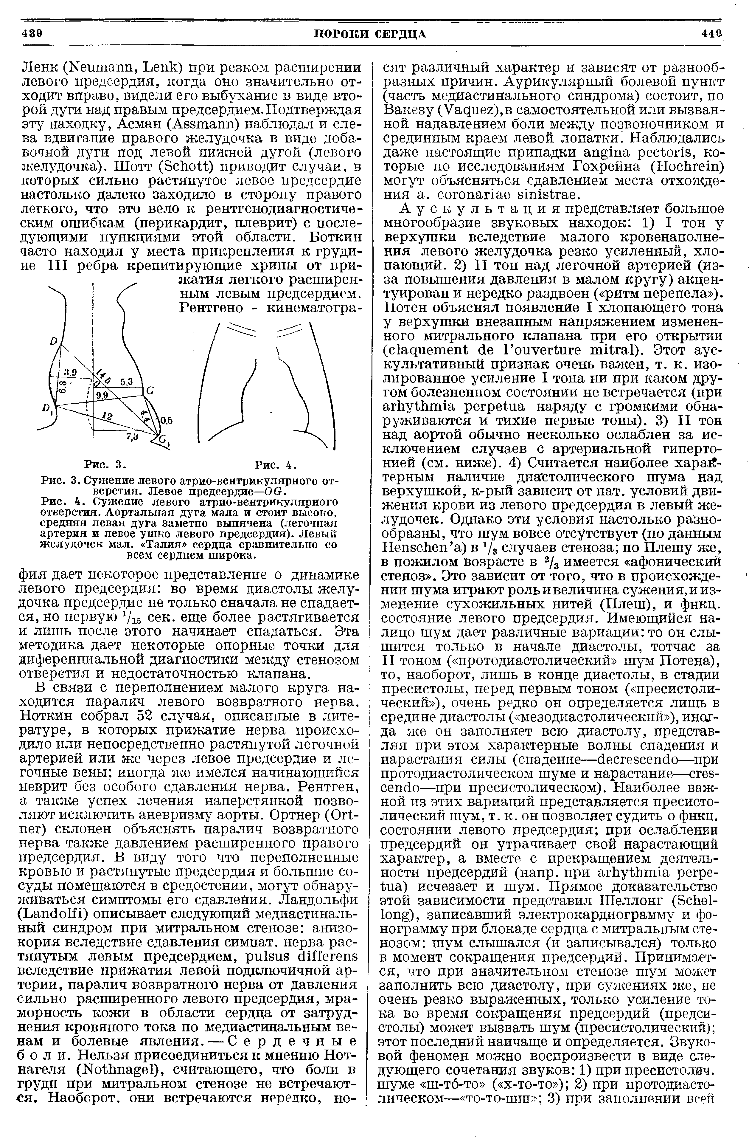 Рис. 4. Сужение левого атрио-вентрикулярного отверстия. Аортальная дуга мала и стоит высоко, средняя левая дуга заметно выпячена (легочная артерия и левое ушко левого предсердия). Левый желудочек мал. Талия сердца сравнительно со всем сердцем широка.