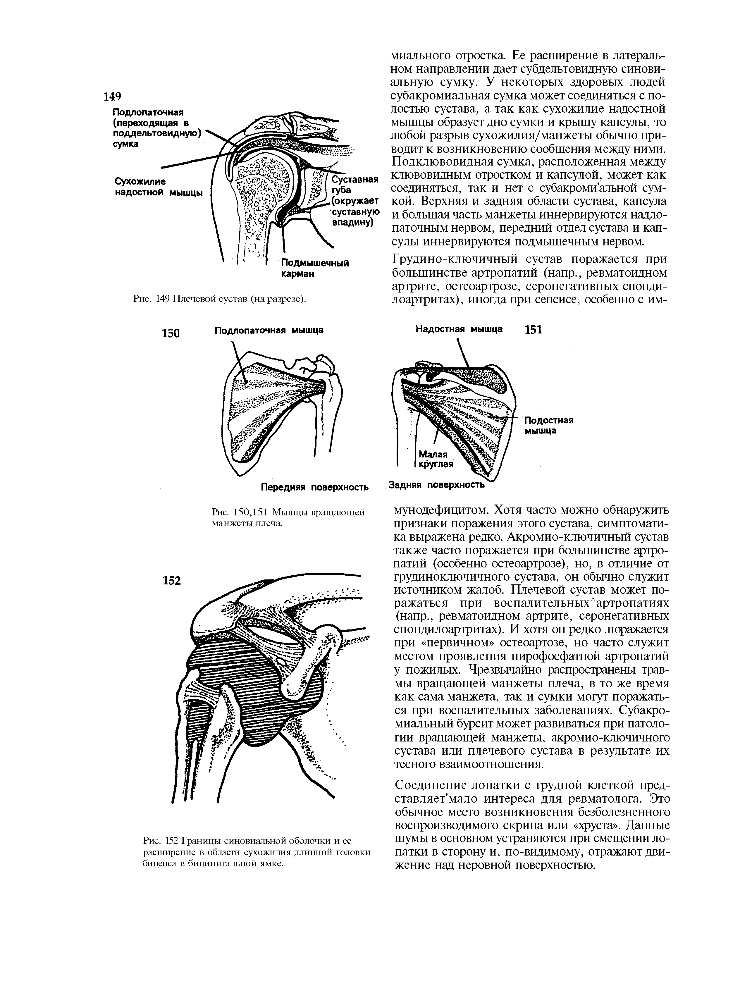 Рис. 152 Границы синовиальной оболочки и ее расширение в области сухожилия длинной головки бицепса в биципитальной ямке.