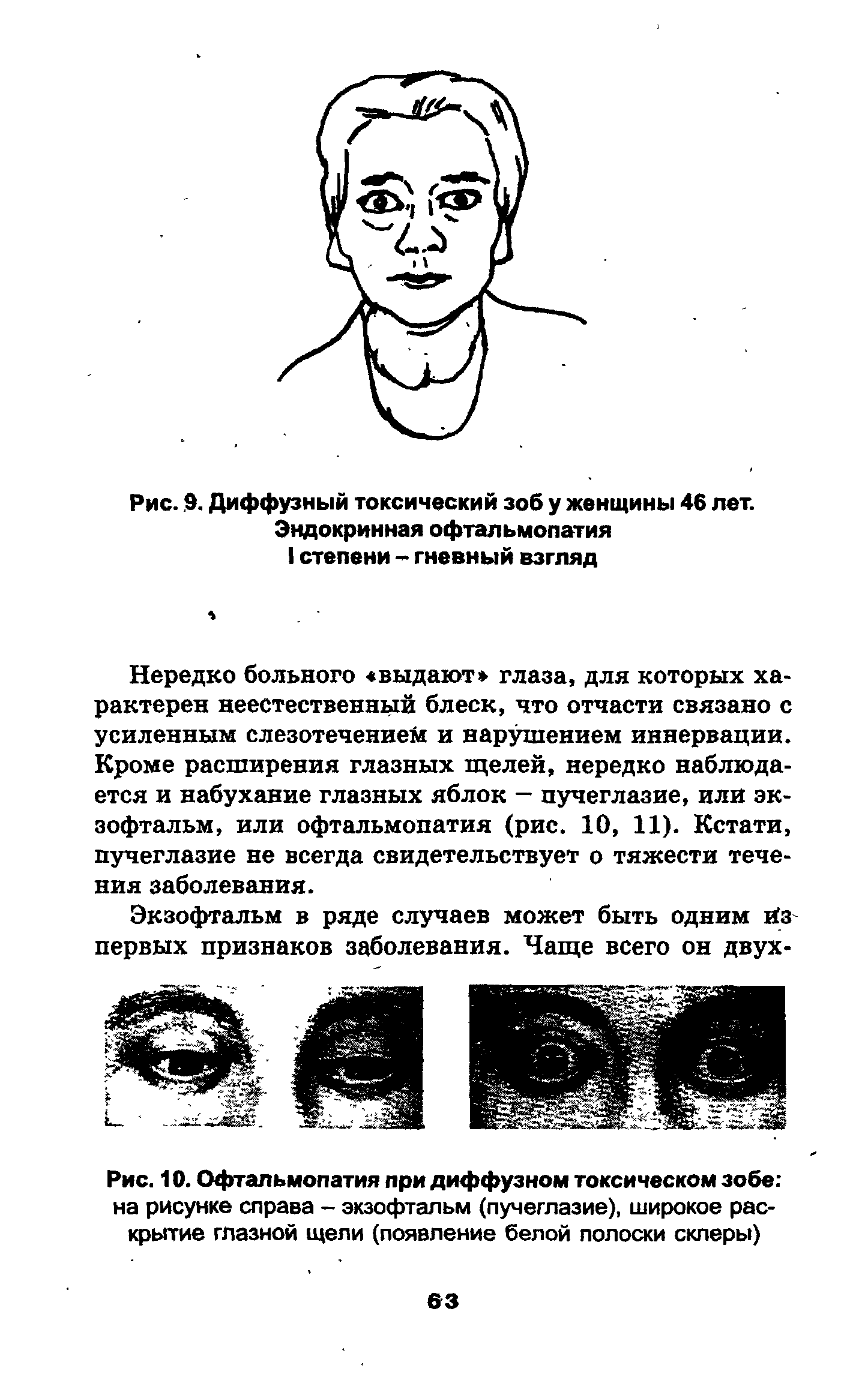 Рис. 10. Офтальмопатия при диффузном токсическом зобе на рисунке справа - экзофтальм (пучеглазие), широкое раскрытие глазной щели (появление белой полоски склеры)...