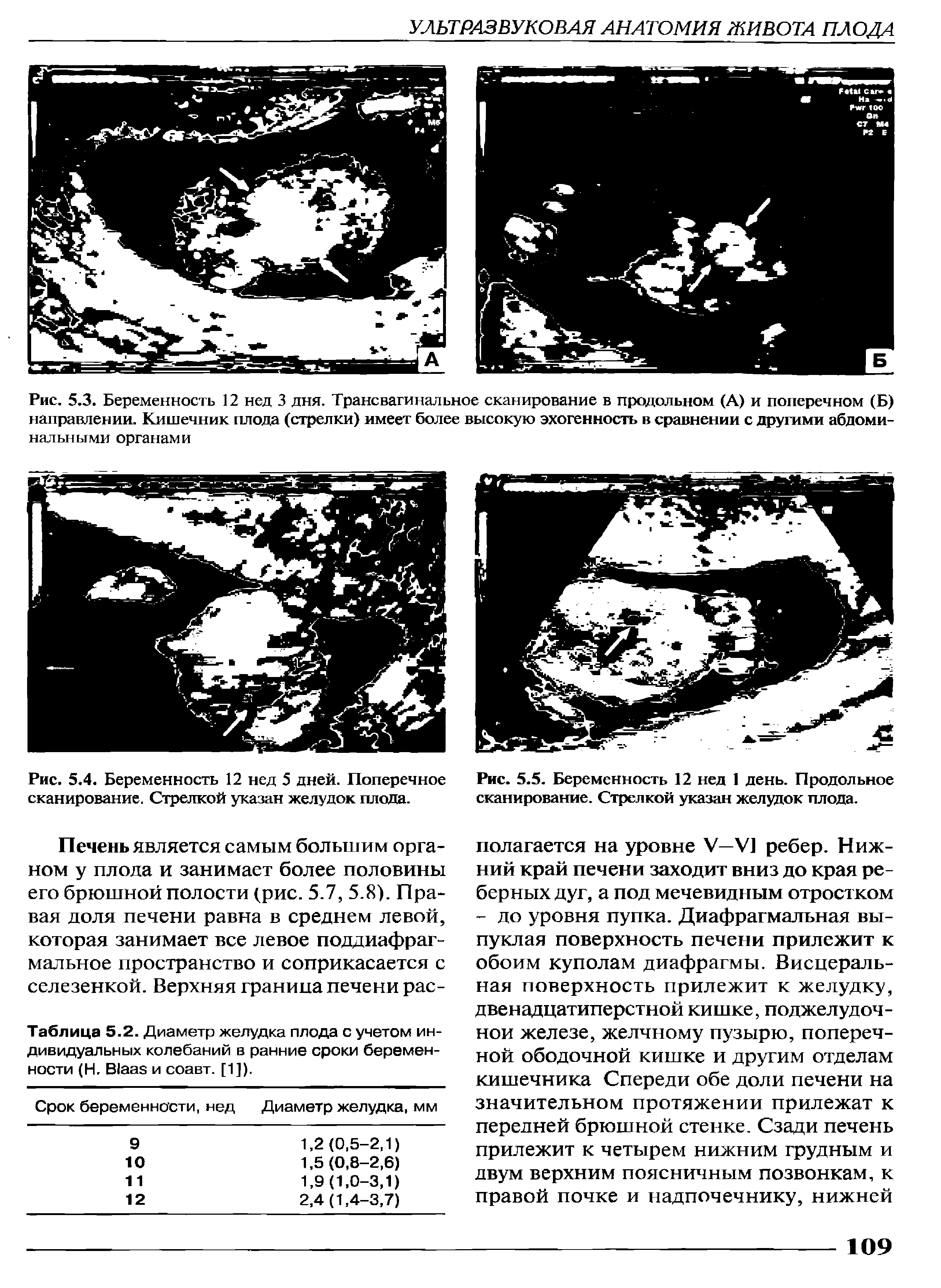 Рис. 5.4. Беременность 12 нед 5 дней. Поперечное сканирование. Стрелкой указан желудок плода.