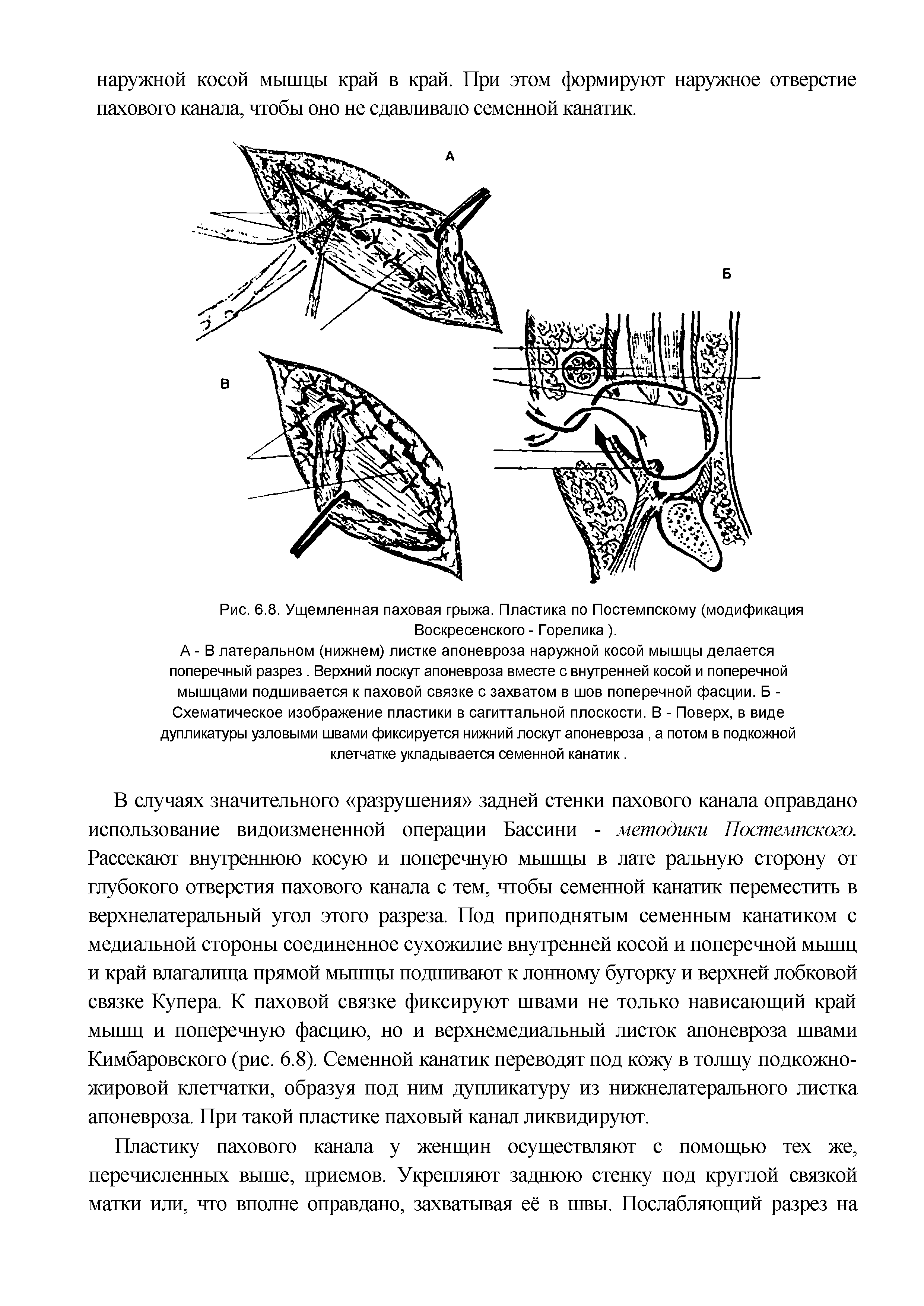 Рис. 6.8. Ущемленная паховая грыжа. Пластика по Постемпскому (модификация Воскресенского - Горелика).