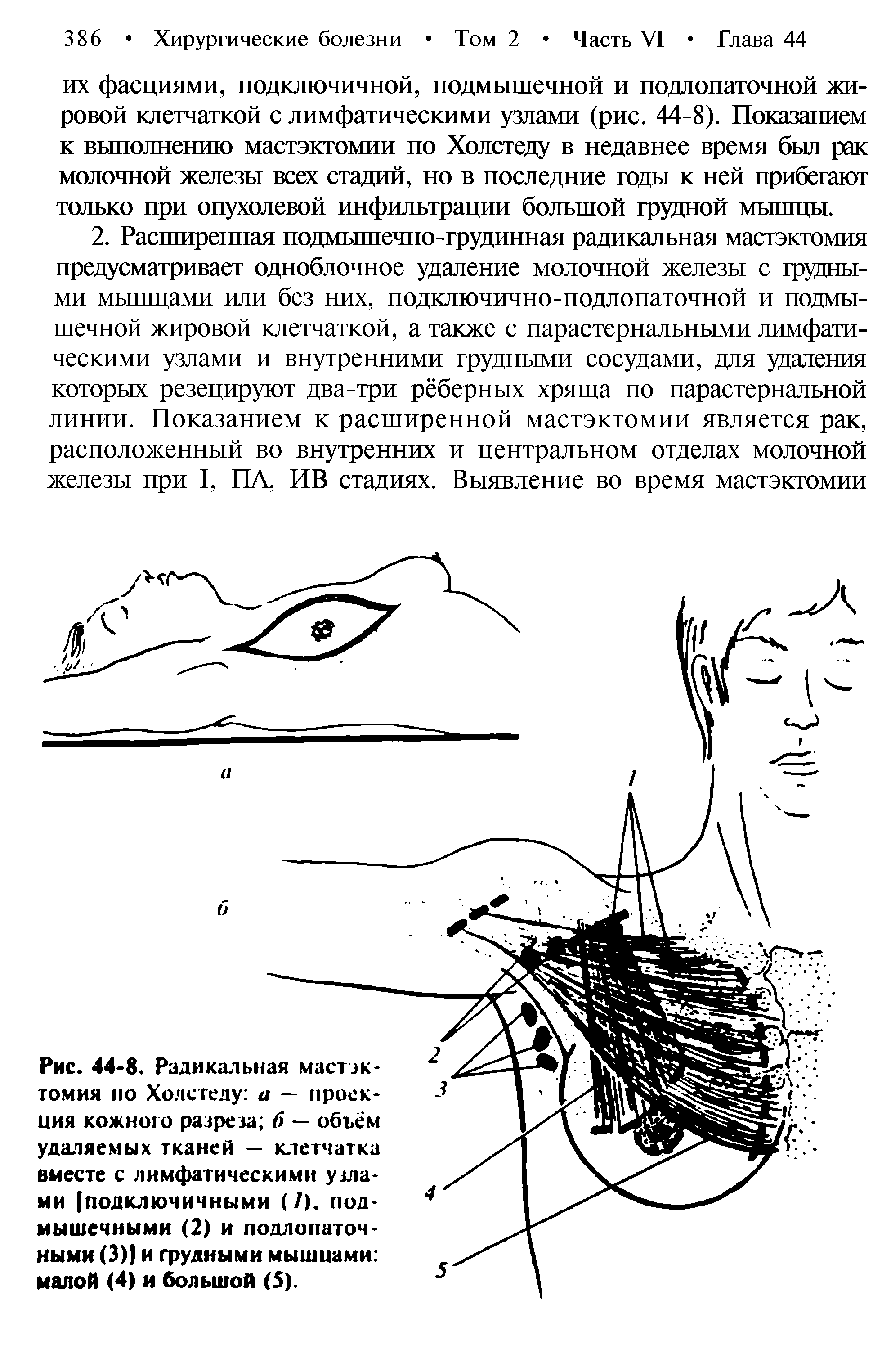 Рис. 44-8. Радикальная мастэктомия по Холстеду а — проекция кожною разреза б — объем удаляемых тканей — клетчатка вместе с лимфатическими узлами [подключичными (/). подмышечными (2) и подлопаточными (3) и грудными мышцами малой (4) и большой (5).