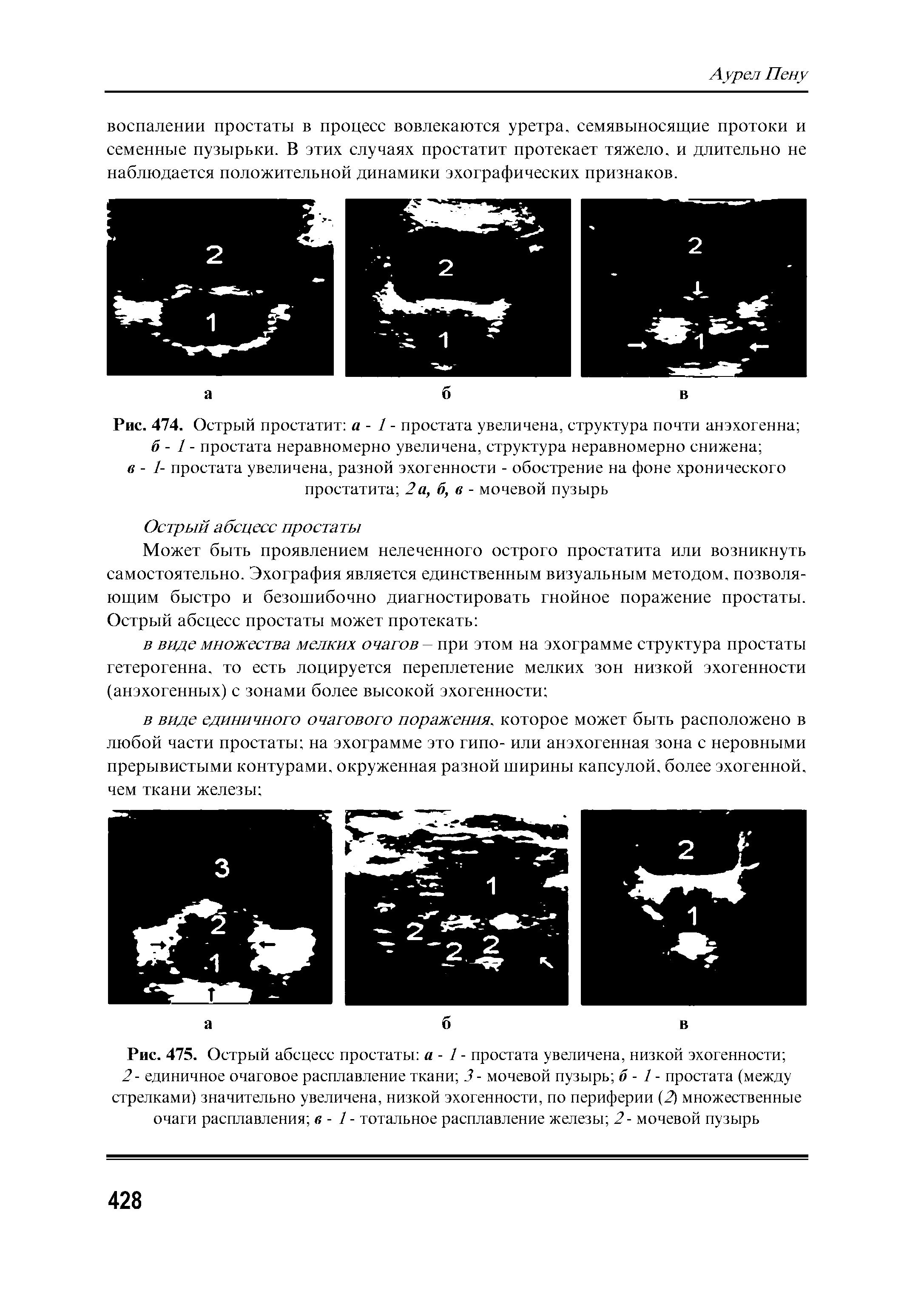 Рис. 475. Острый абсцесс простаты а - 1 - простата увеличена, низкой эхогенности ...