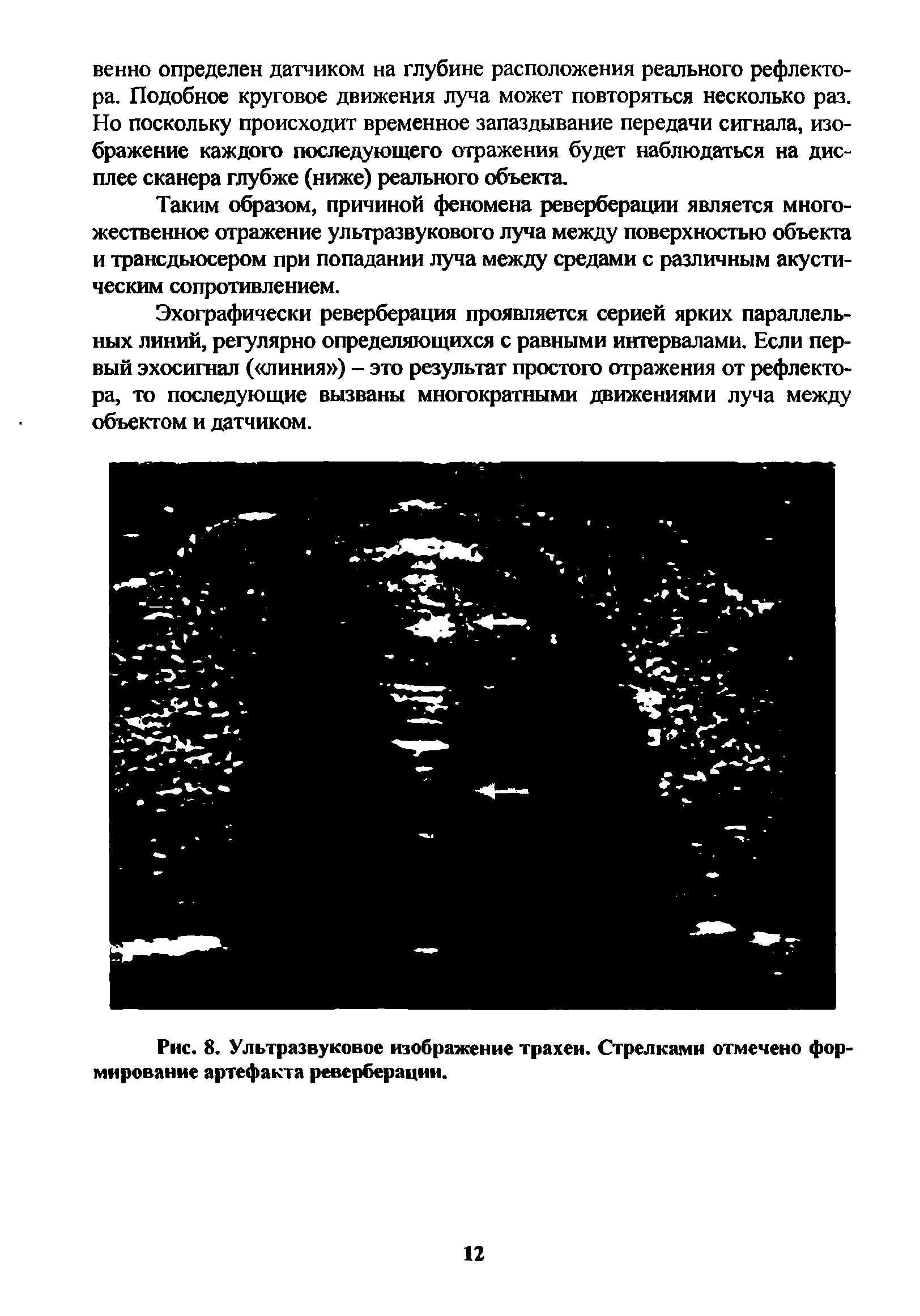 Рис. 8. Ультразвуковое изображение трахеи. Стрелками отмечено формирование артефакта реверберации.