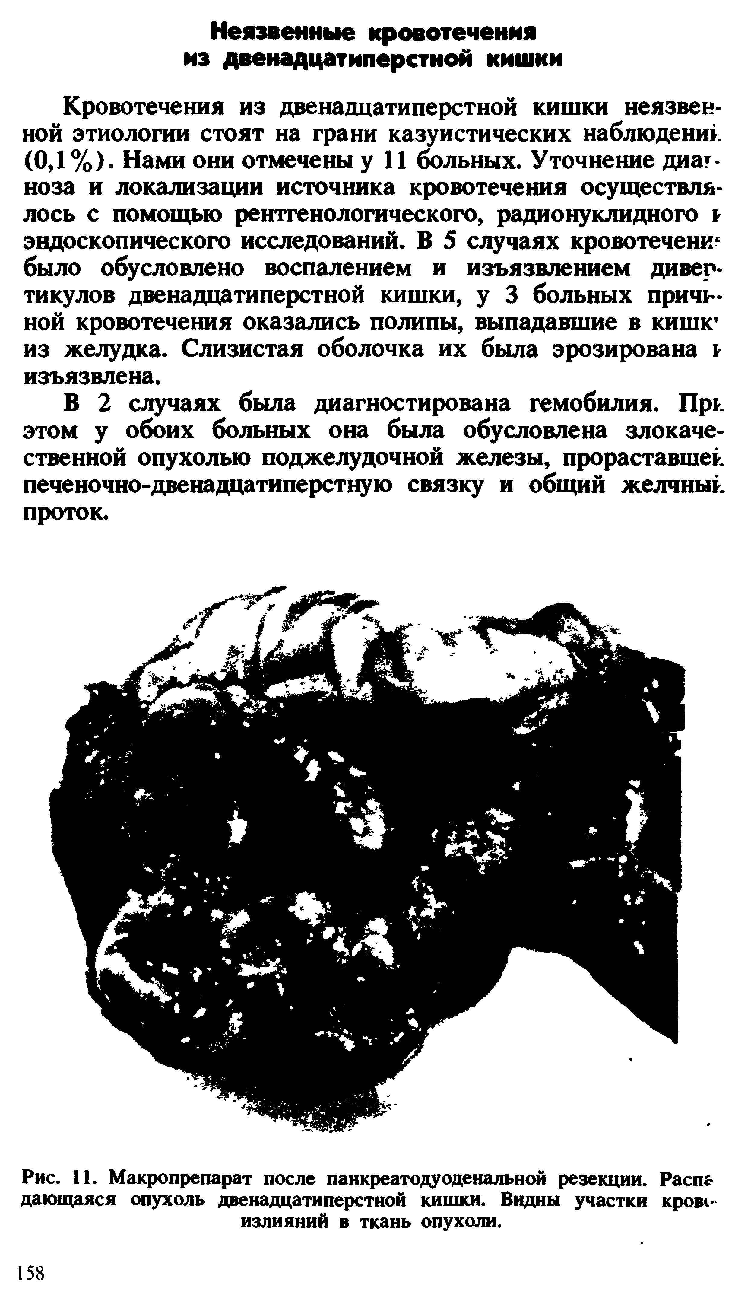 Рис. 11. Макропрепарат после панкреатодуоденальной резекции. Распа дающаяся опухоль двенадцатиперстной кишки. Видны участки крове излияний в ткань опухоли.