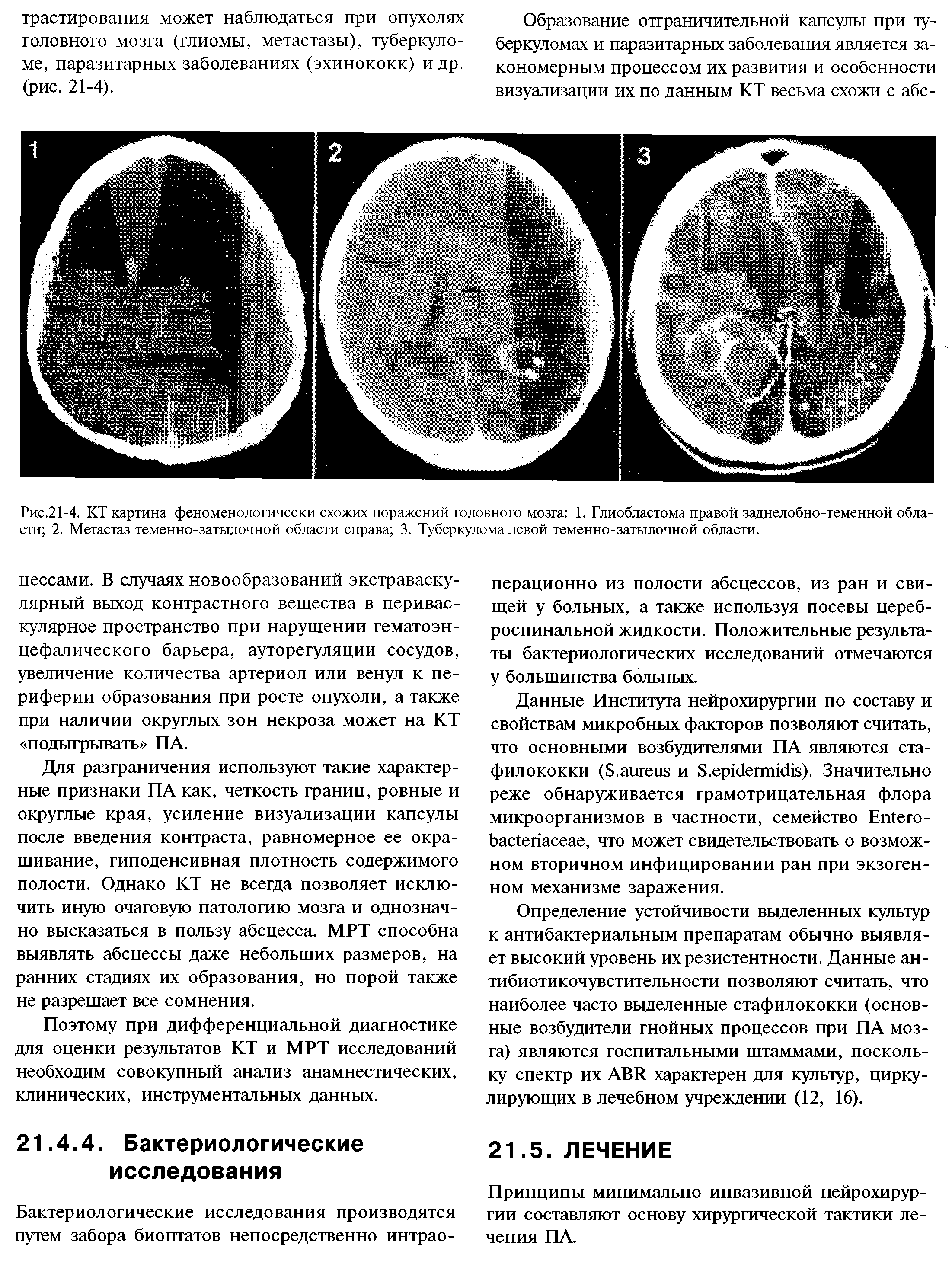 Рис.21-4. КТ картина феноменологически схожих поражений головного мозга 1. Глиобластома правой заднелобно-теменной области 2. Метастаз теменно-затылочной области справа 3. Туберкулома левой теменно-затылочной области.