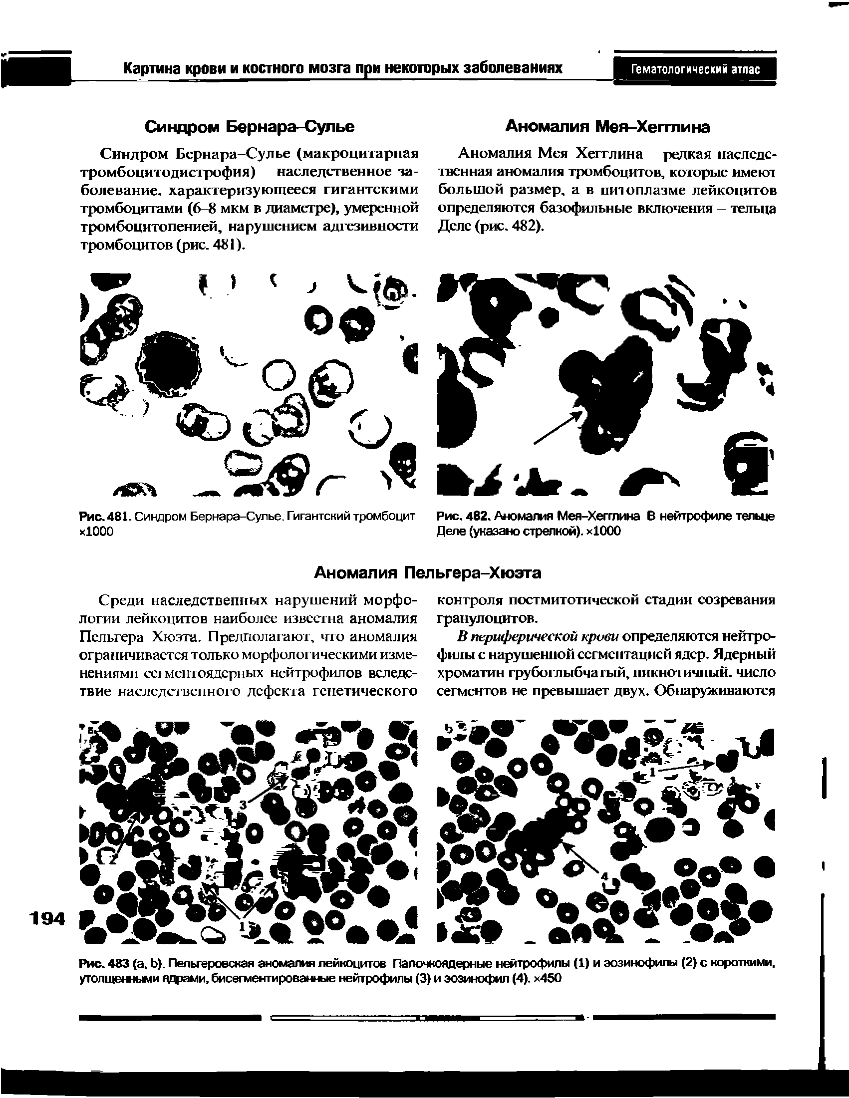 Рис. 481. Синдром Бернара-Сулье. Гигантский тромбоцит Рис. 482. Аномалия Мея-Хегглина В нейтрофиле тельце хЮОО Деле (указано стрелкой). х1000...