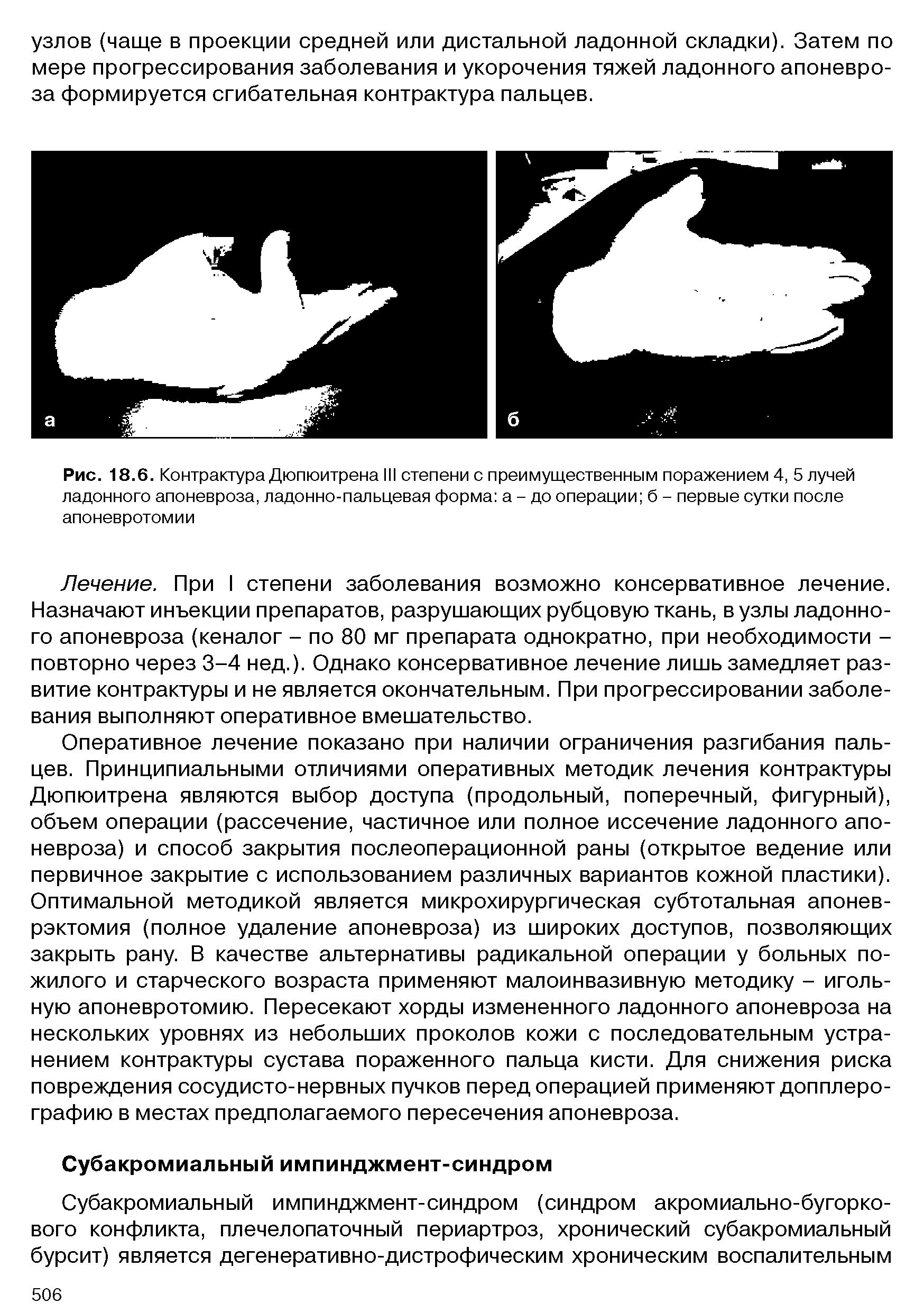 Рис. 18.6. Контрактура Дюпюитрена III степени с преимущественным поражением 4, 5 лучей ладонного апоневроза, ладонно-пальцевая форма а - до операции б - первые сутки после апоневротомии...