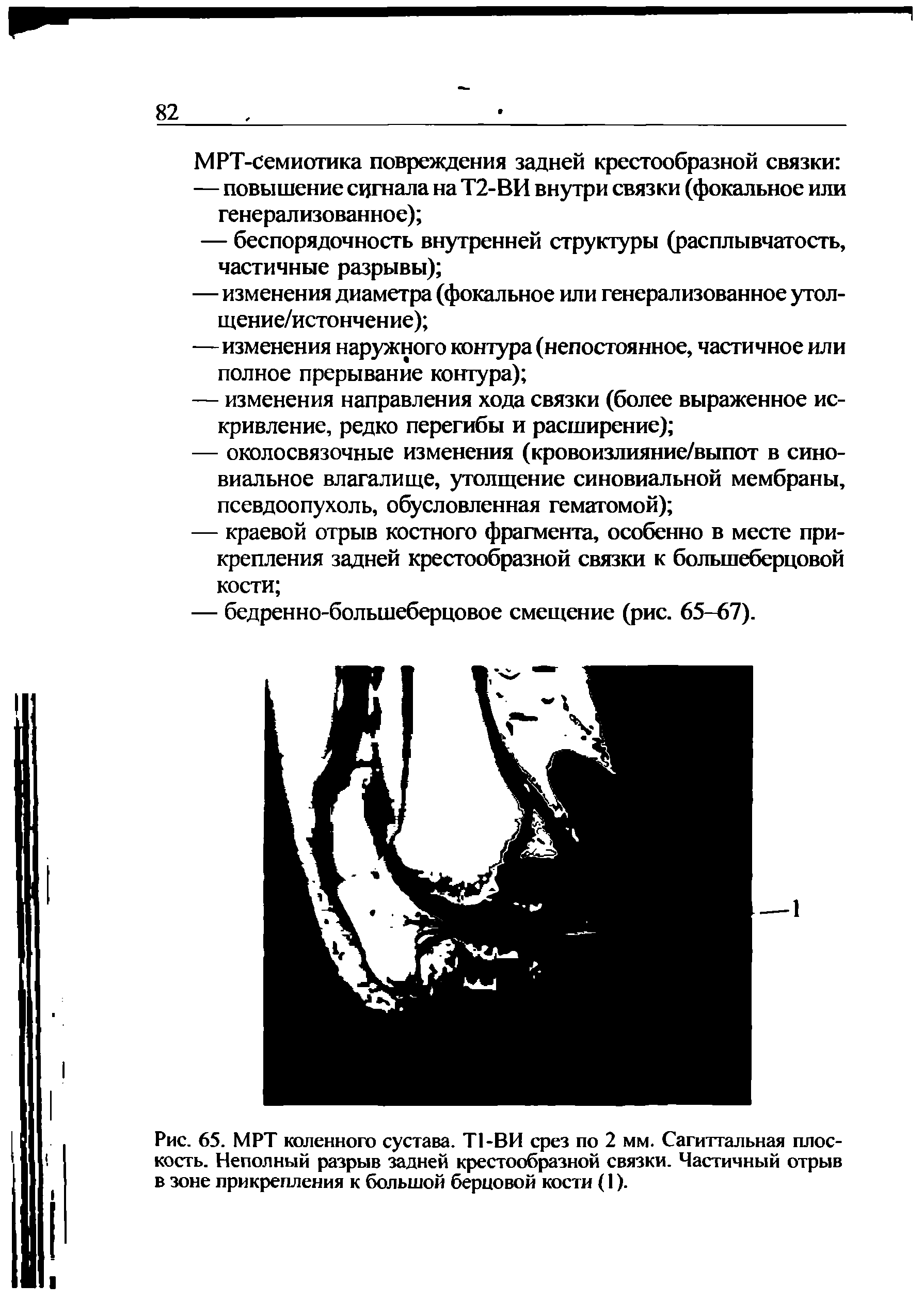 Рис. 65. МРТ коленного сустава. Т1-ВИ срез по 2 мм. Сагиттальная плоскость. Неполный разрыв задней крестообразной связки. Частичный отрыв в зоне прикрепления к большой берцовой кости (1).