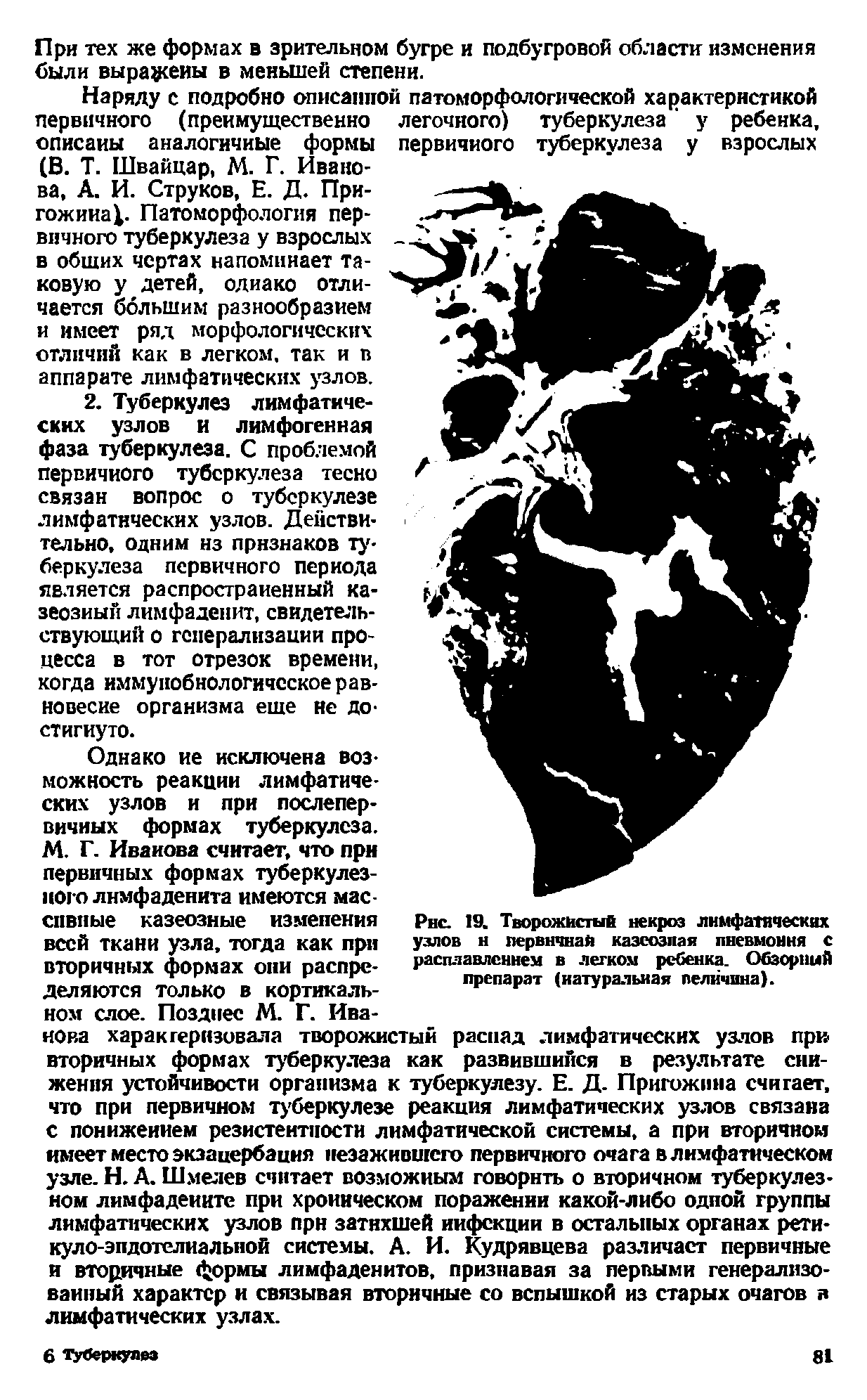 Рис. 1У. Творожистый некроз лимфатических узлов н первичная казеозная пневмония с расплавлением в легком ребенка. Обзорный препарат (натуральная величина).