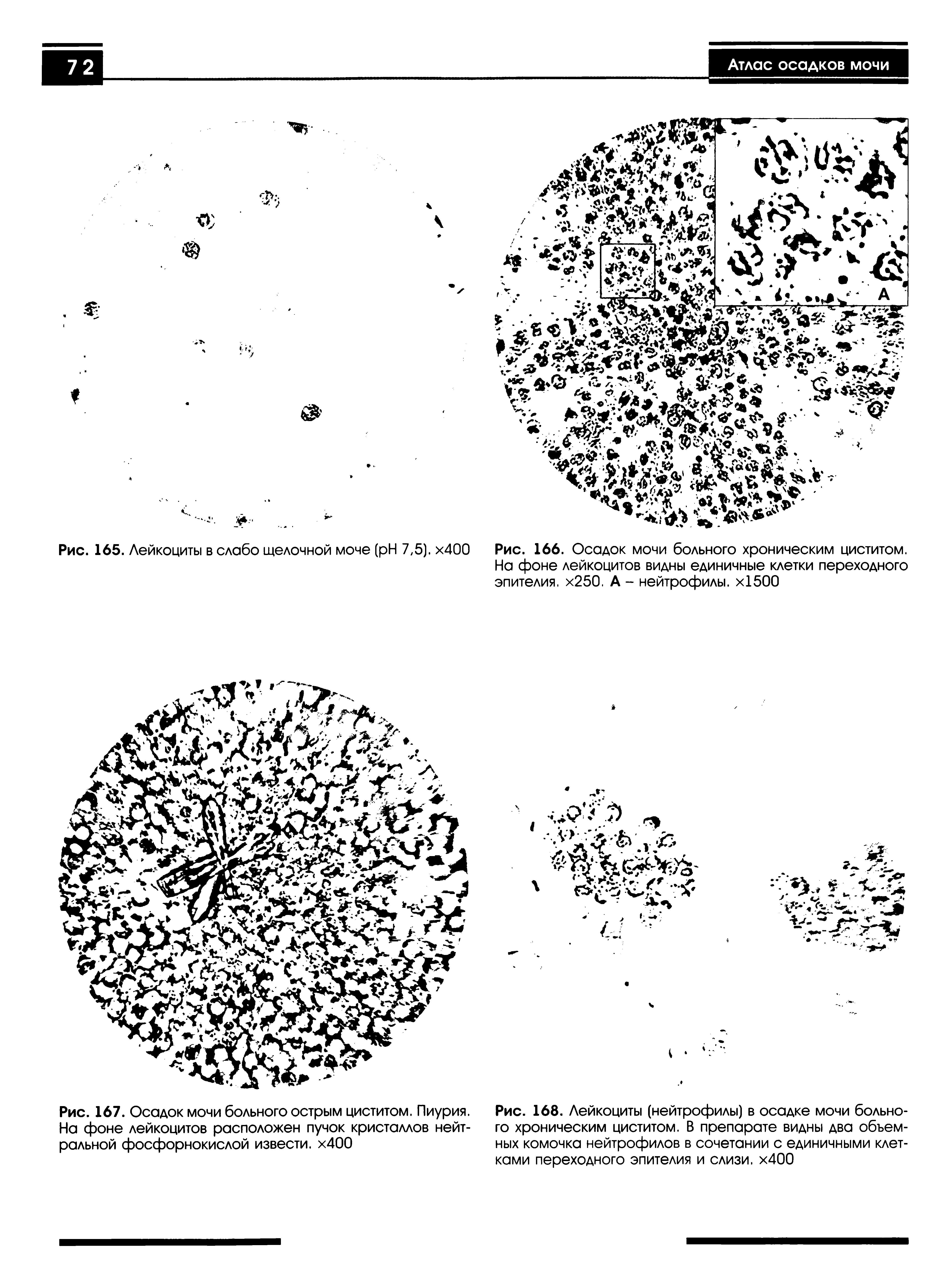 Рис. 168. Лейкоциты (нейтрофилы) в осадке мочи больного хроническим циститом. В препарате видны два объемных комочка нейтрофилов в сочетании с единичными клетками переходного эпителия и слизи. х400...