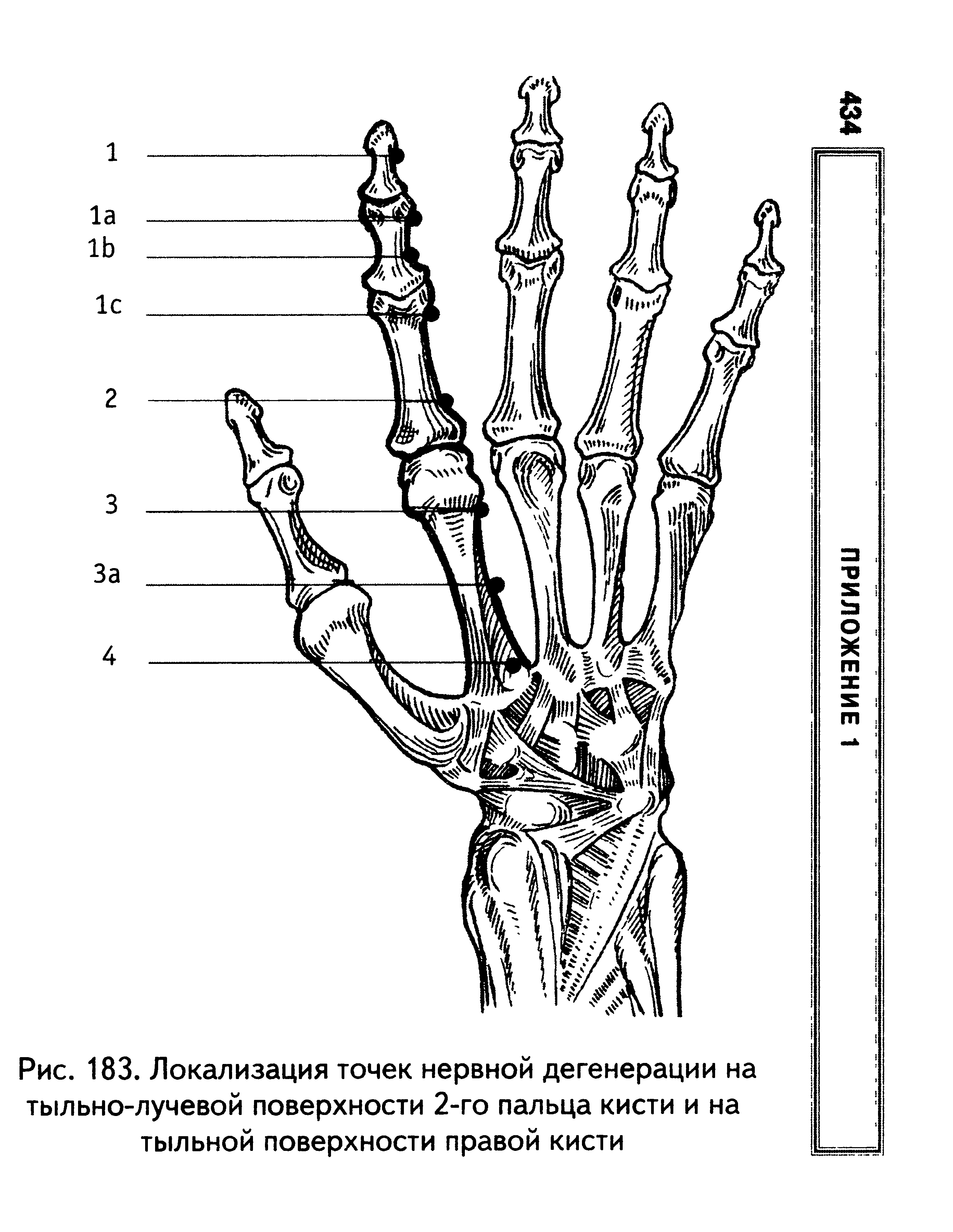 Рис. 183. Локализация точек нервной дегенерации на тыльно-лучевой поверхности 2-го пальца кисти и на тыльной поверхности правой кисти...