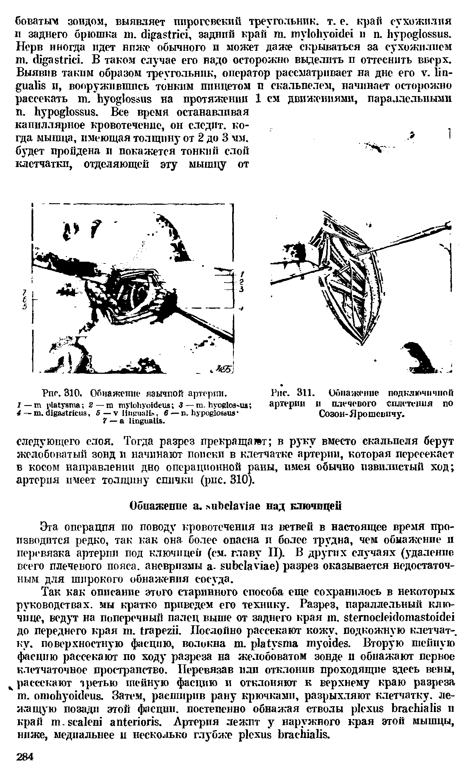 Рис. 311. Обнажение подключичной артерии и плечевого сплетения по Созой-Я рошевпчу.