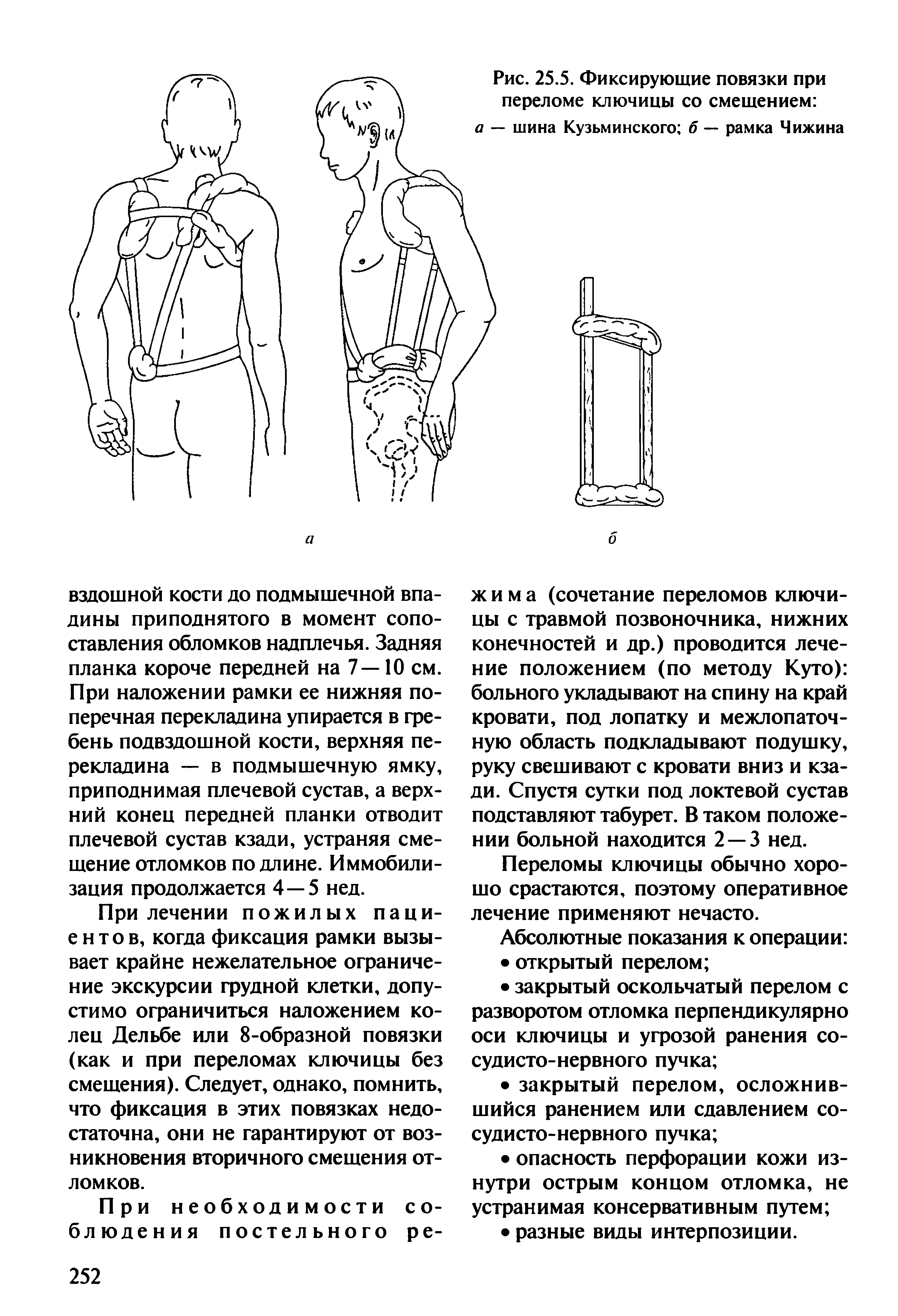 Рис. 25.5. Фиксирующие повязки при переломе ключицы со смещением а — шина Кузьминского б — рамка Чижина...