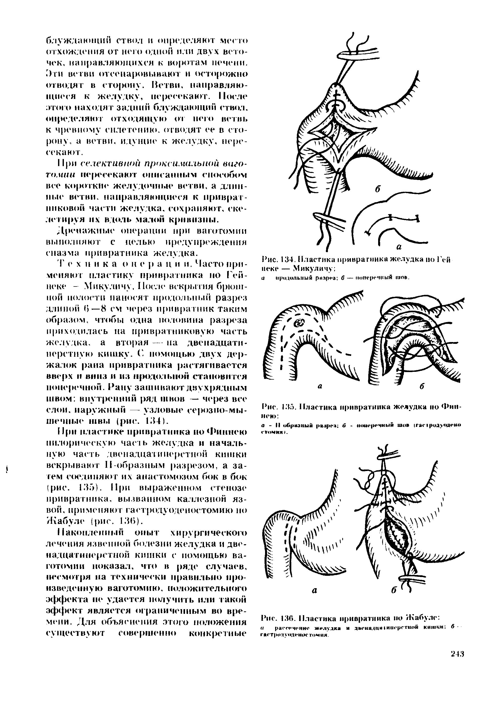 Рис. 136. Пластика привратника ио /Кабуле рассечение желудка и дьенадциIинсрстной кишки 6-гастродуоденостомия...