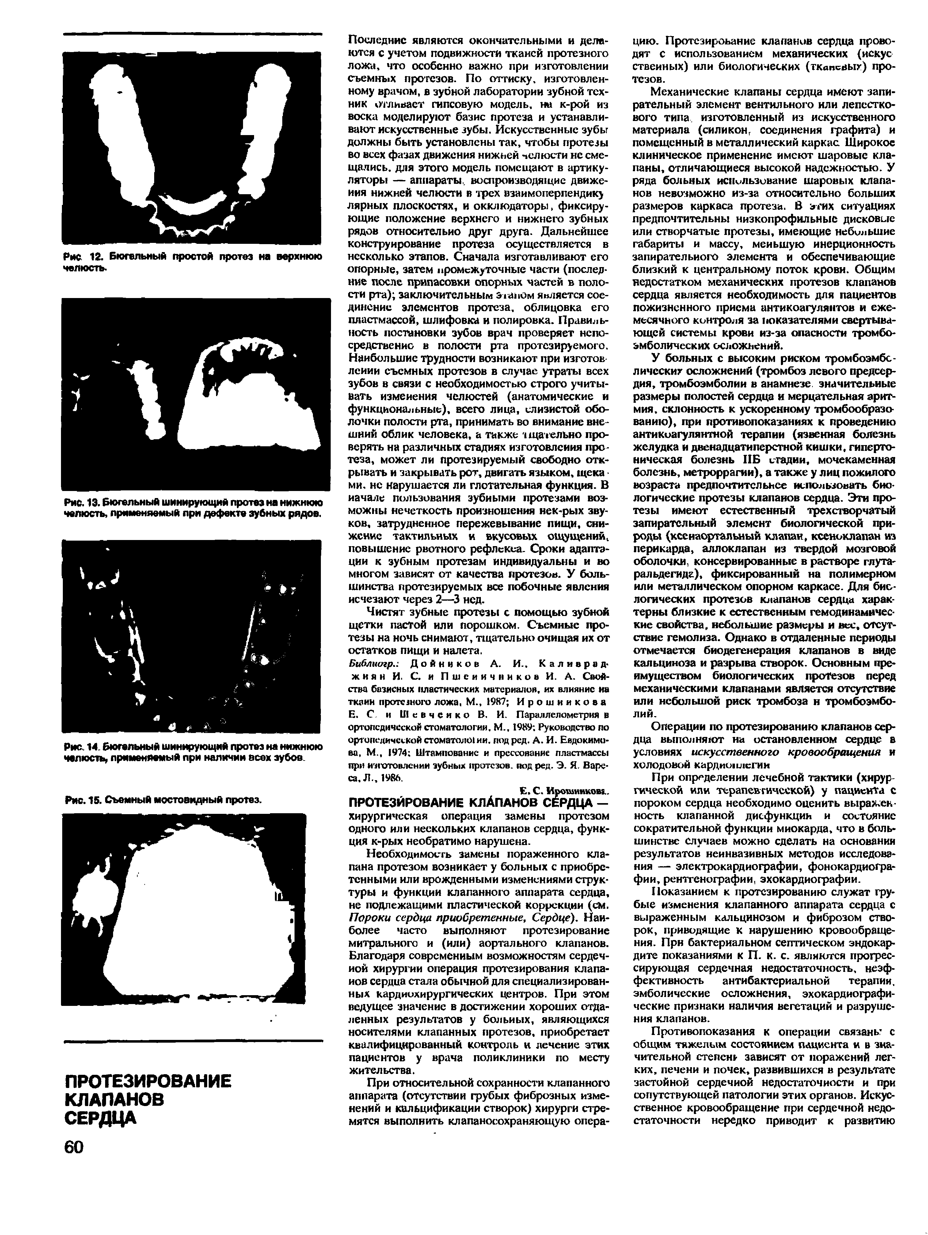 Рис. 13. Бюгельный шинирующий протез на нижнюю челюсть, применяемый при дефекте зубных рядов.